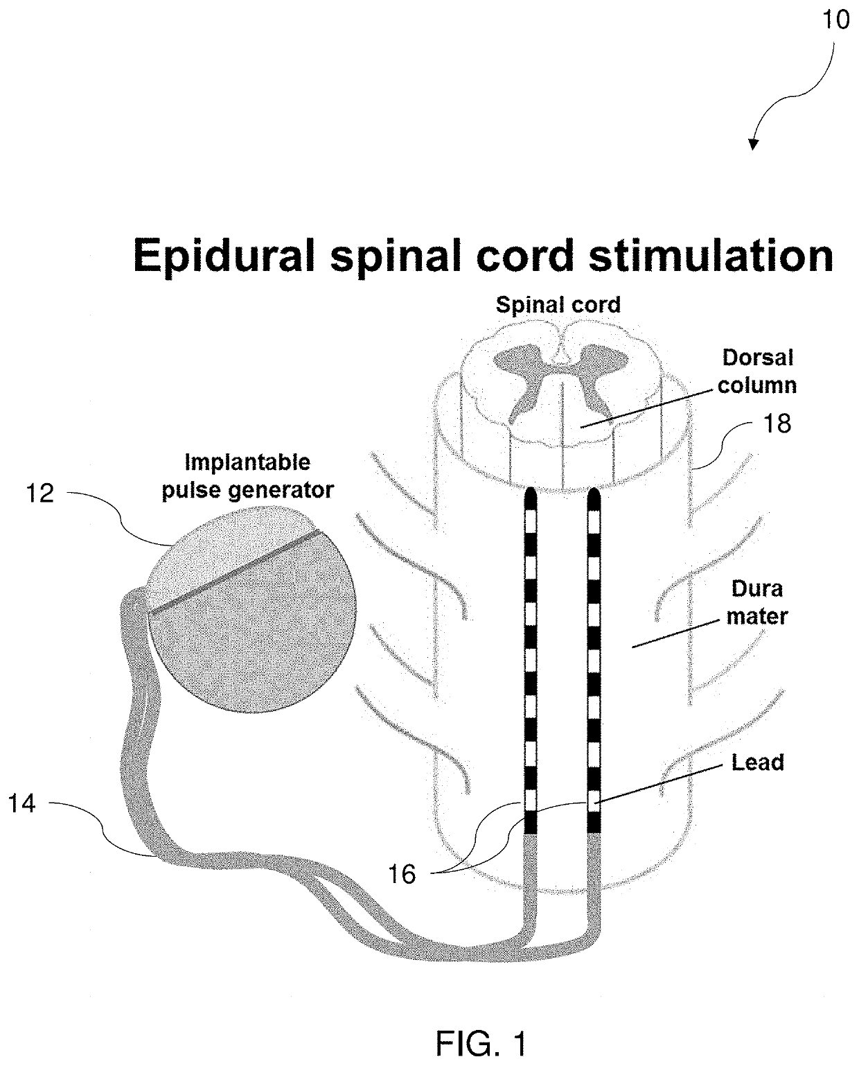Systems, devices and methods for treatment using spinal cord stimulation by selectively reducing the activity of the sympathetic nervous system  18039