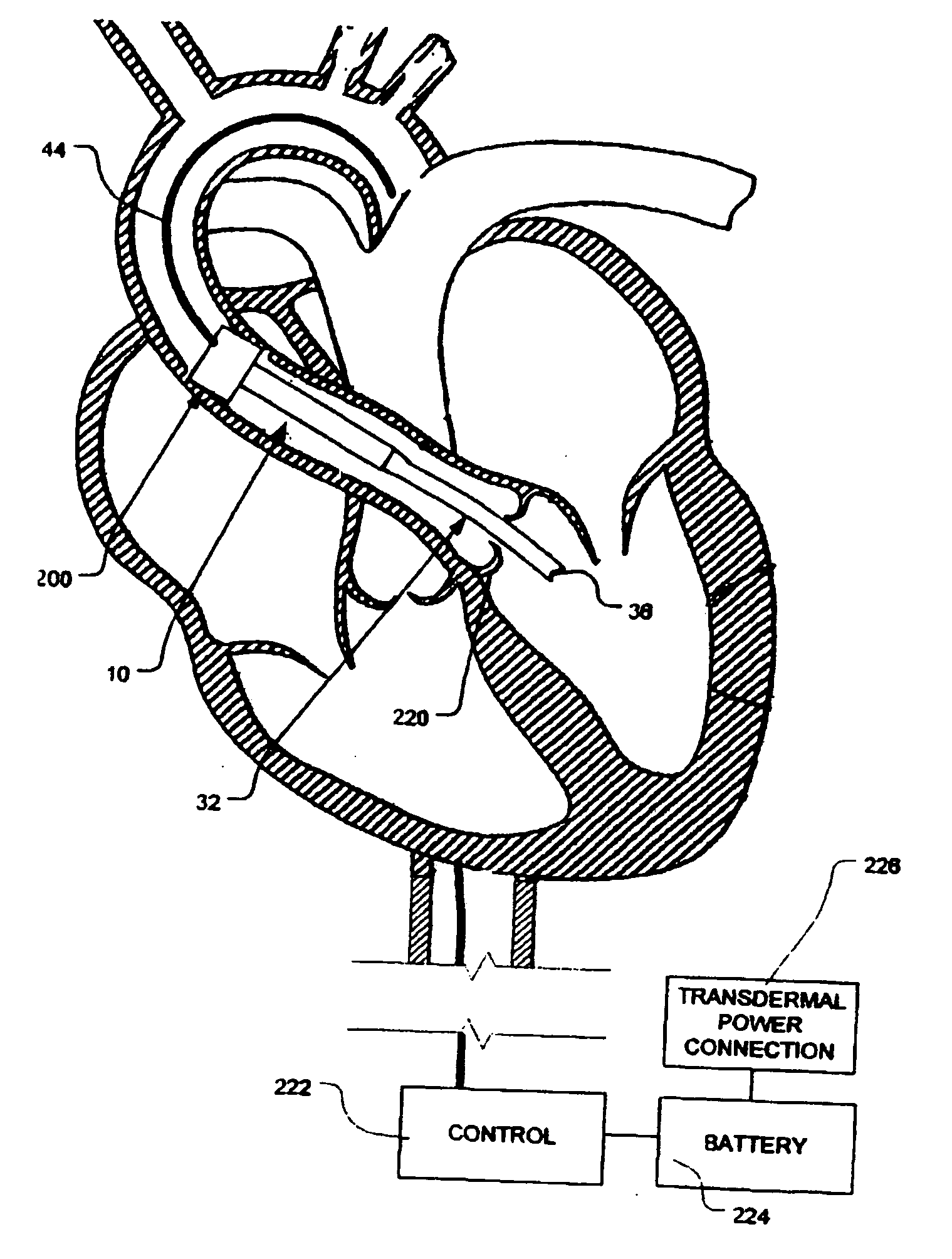 Intravascular ventricular assist device