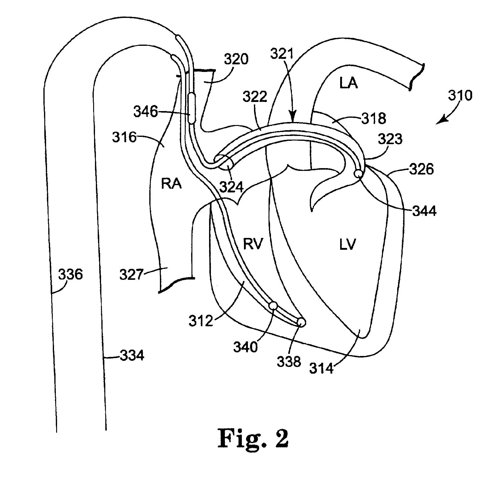 System and method for treating an adverse cardiac condition using combined pacing and drug delivery