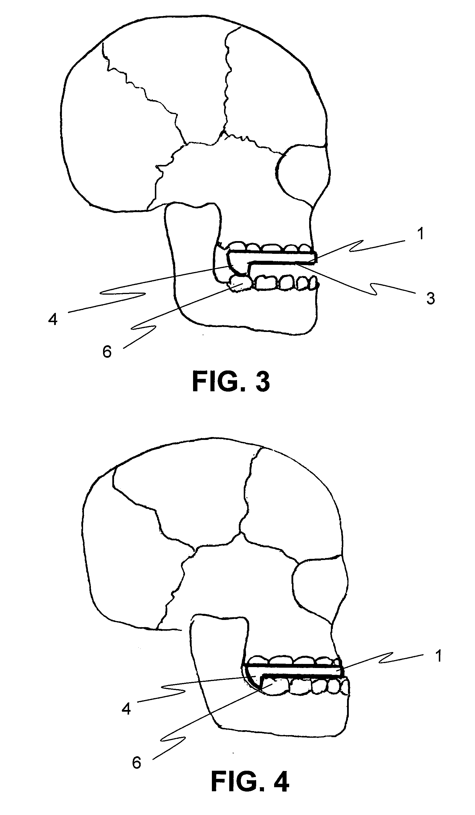 Mandibular Advancement Mouthpiece, An Intraoccusal Removable Improved Device For Eliminating Or Reducing Snoring