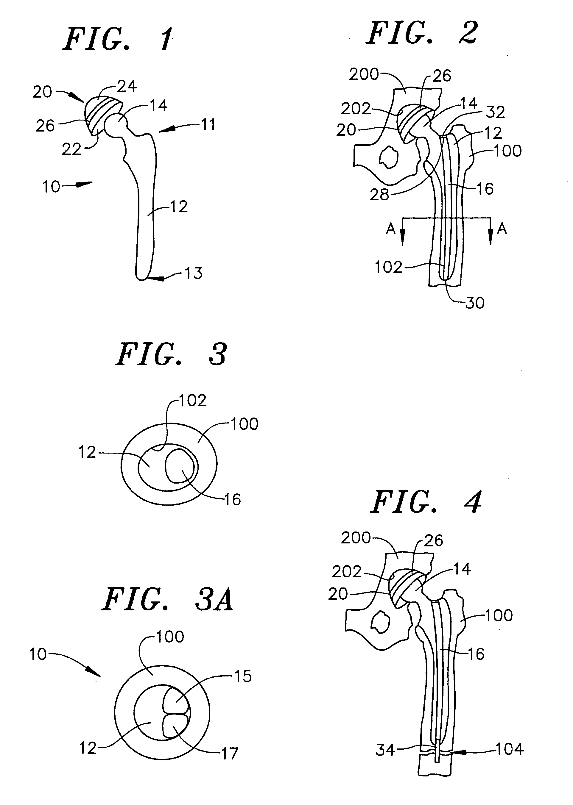 Cannulated femoral hip implant apparatus