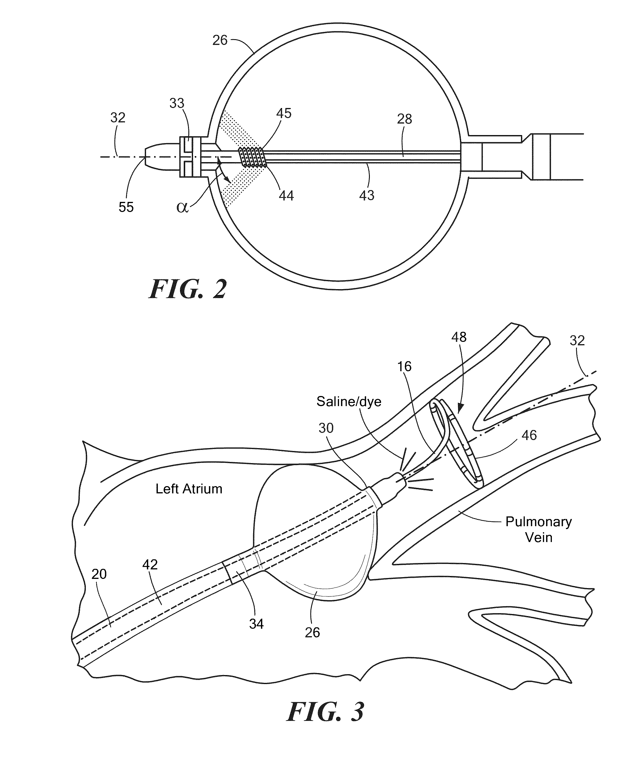 Determination of pulmonary vein and other vascular occlusion using temperature profile following cold saline injection