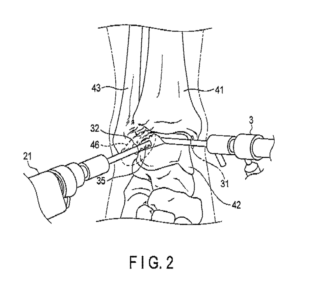 Arthroscopic surgery method for ankle ligament reconstruction