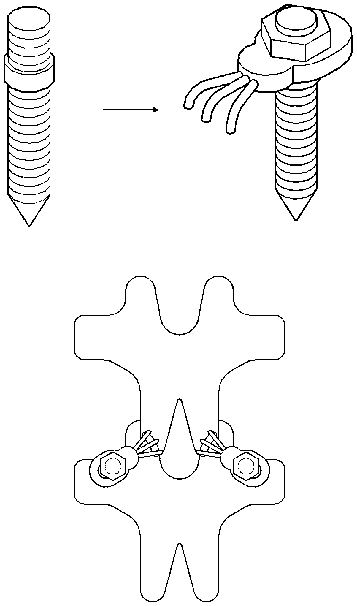 A lumbar facet joint tension band fixator