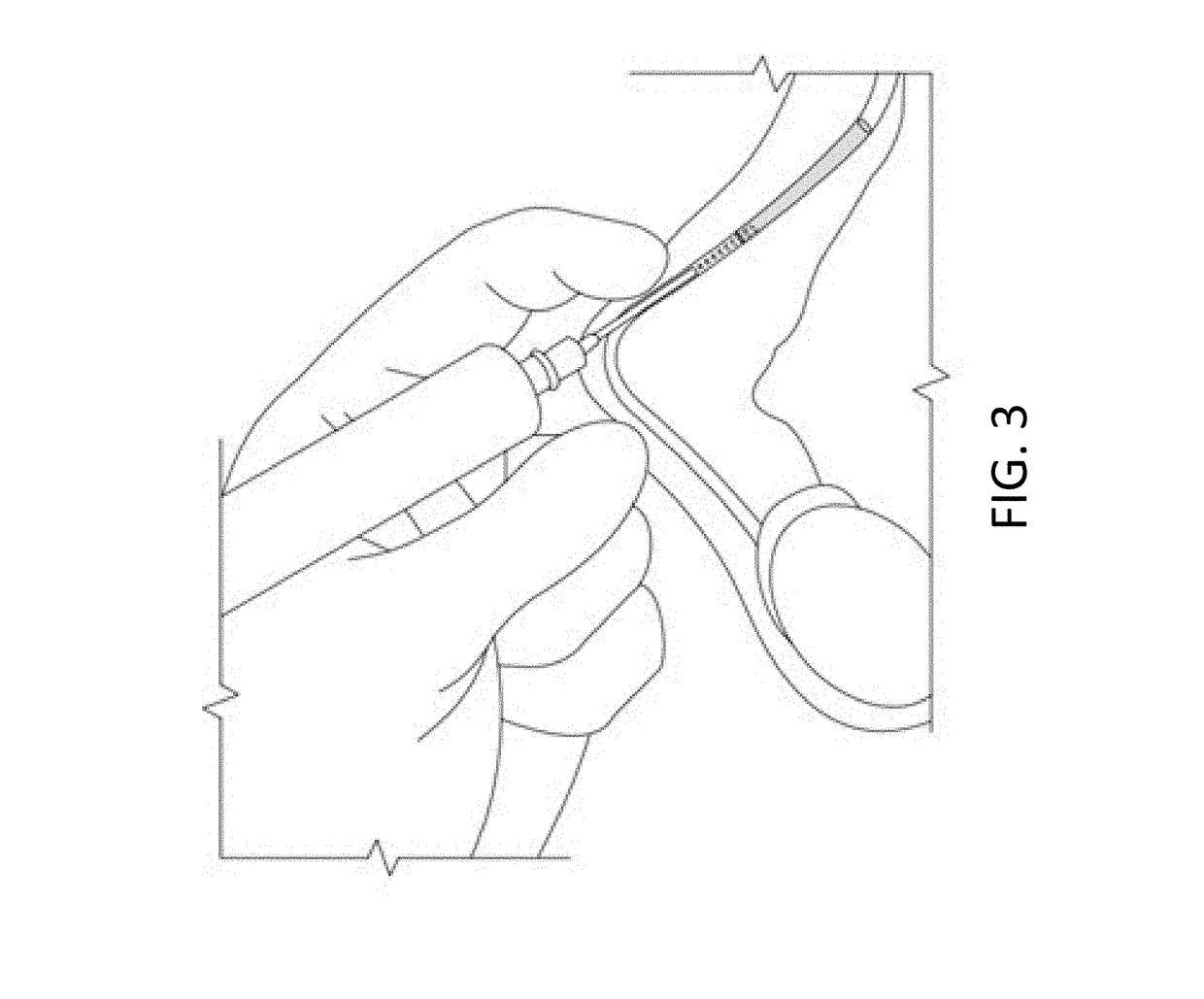 Long-lasting and degradable implant compositions