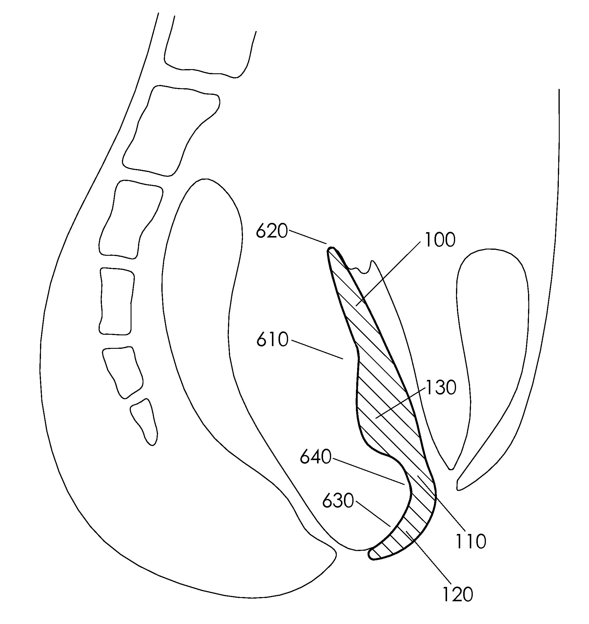 Female posterior wall prosthesis