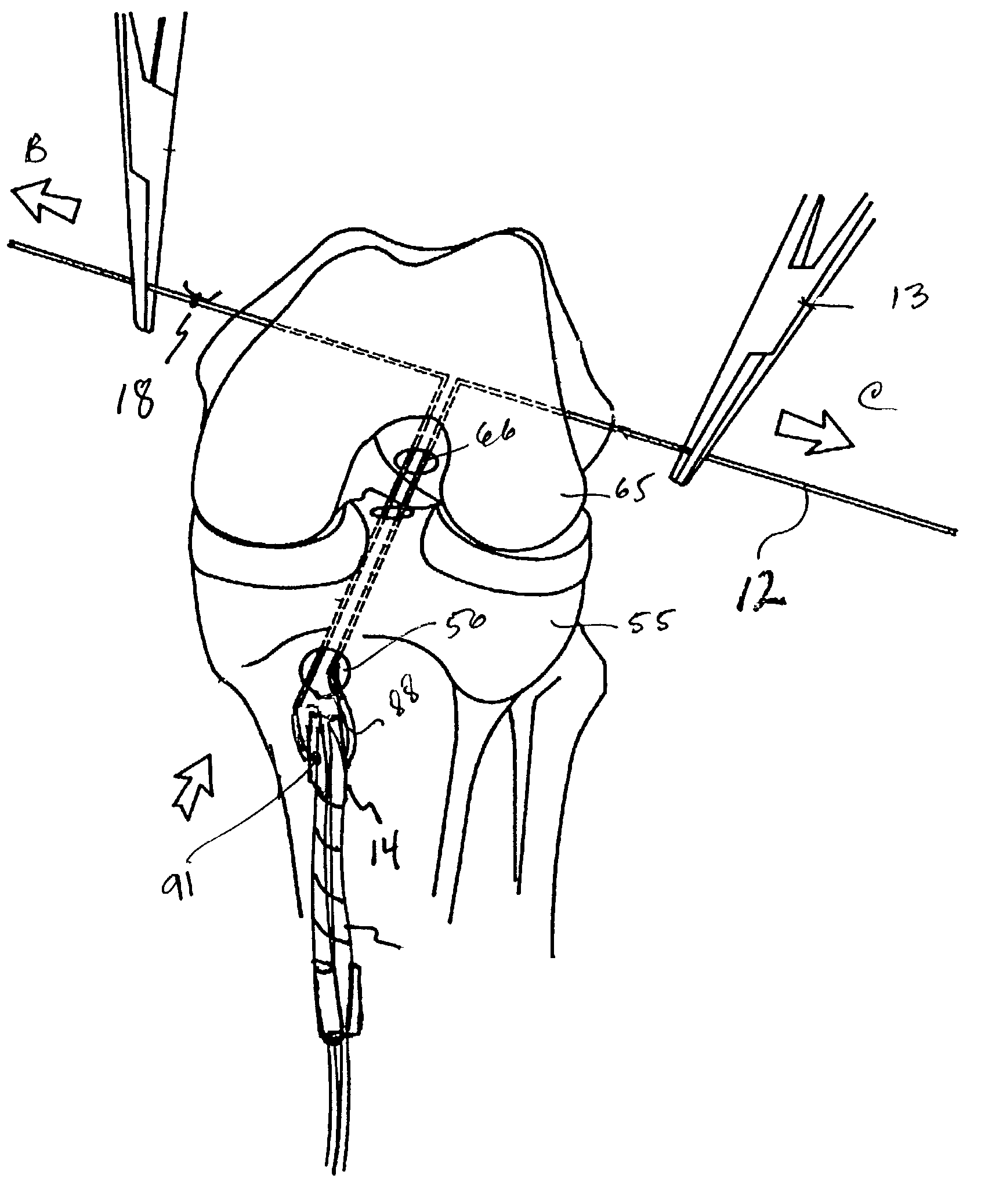 Transverse fixation technique for ACL reconstruction using bone-tendon-bone graft