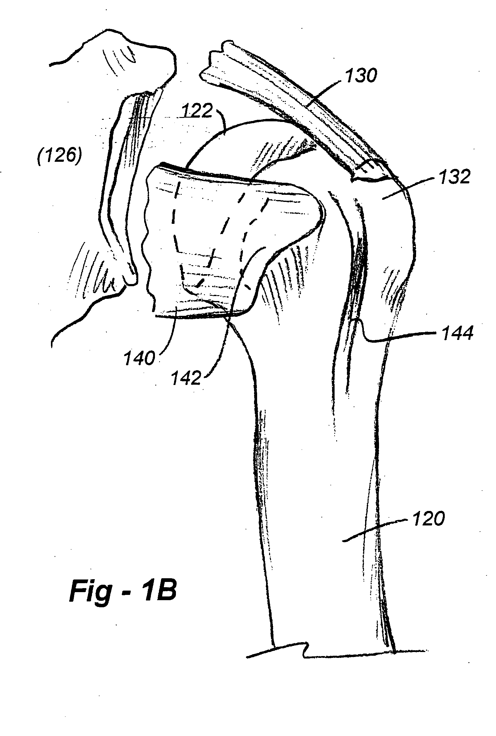Shoulder prosthesis with anatomic reattachment features