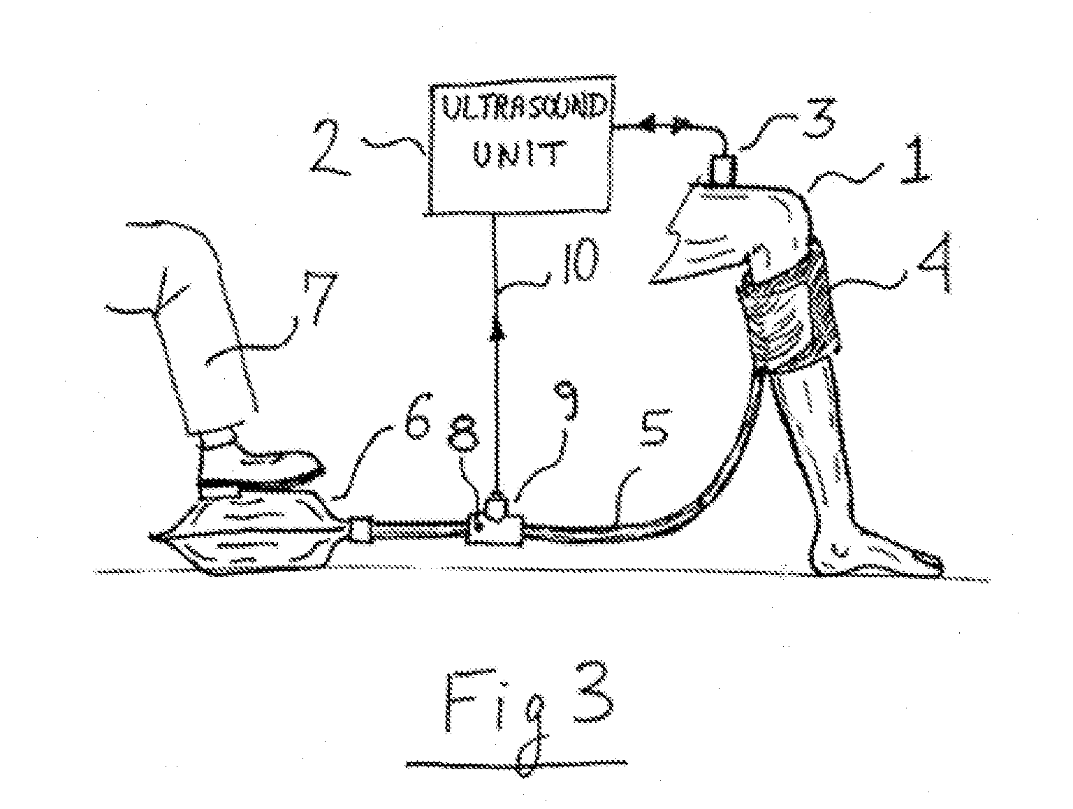 Cuff for Accentuating Venous Flow