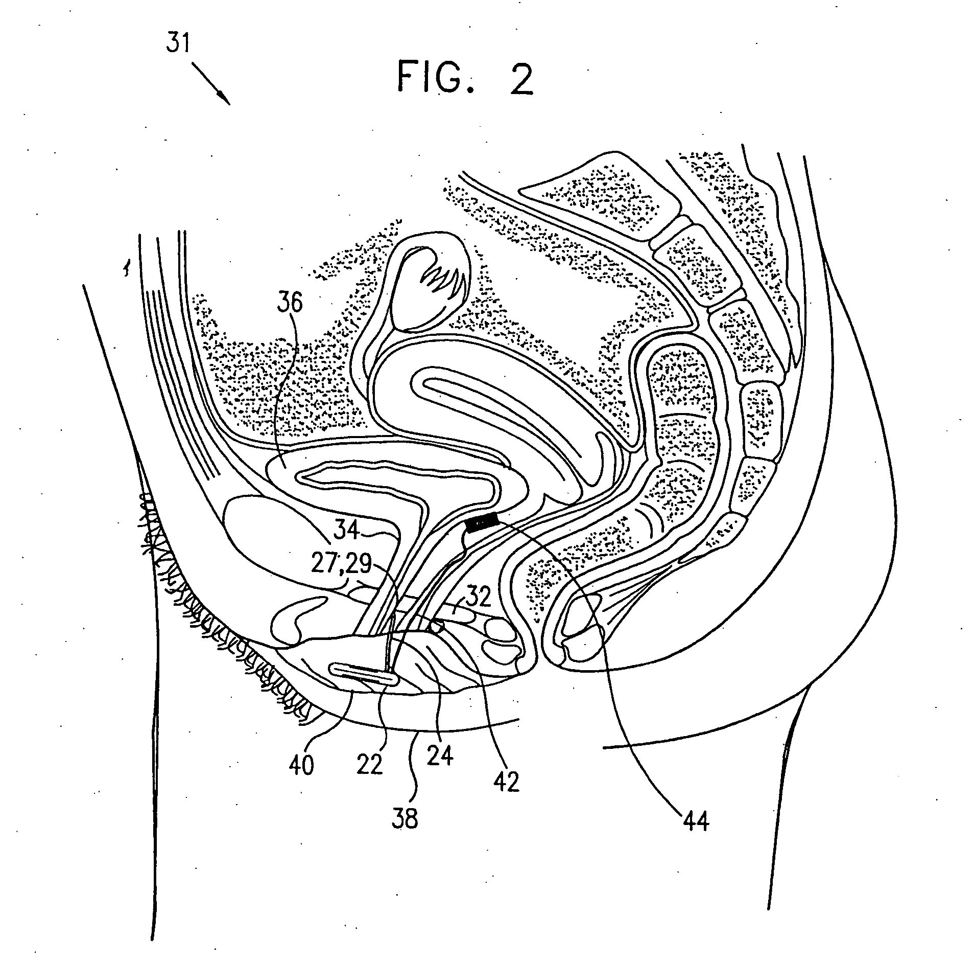 Incontinence treatment device