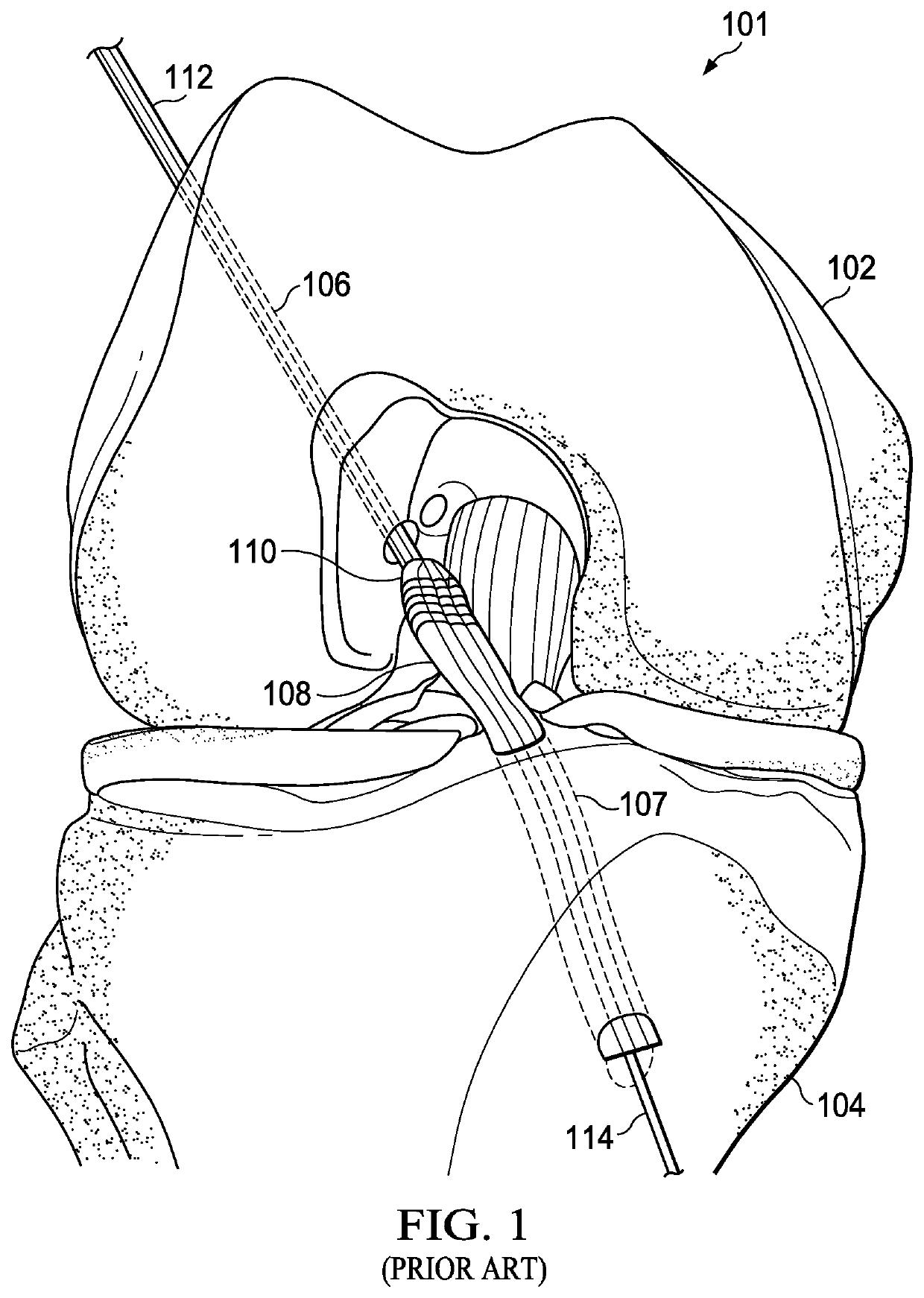 Graft Compression System