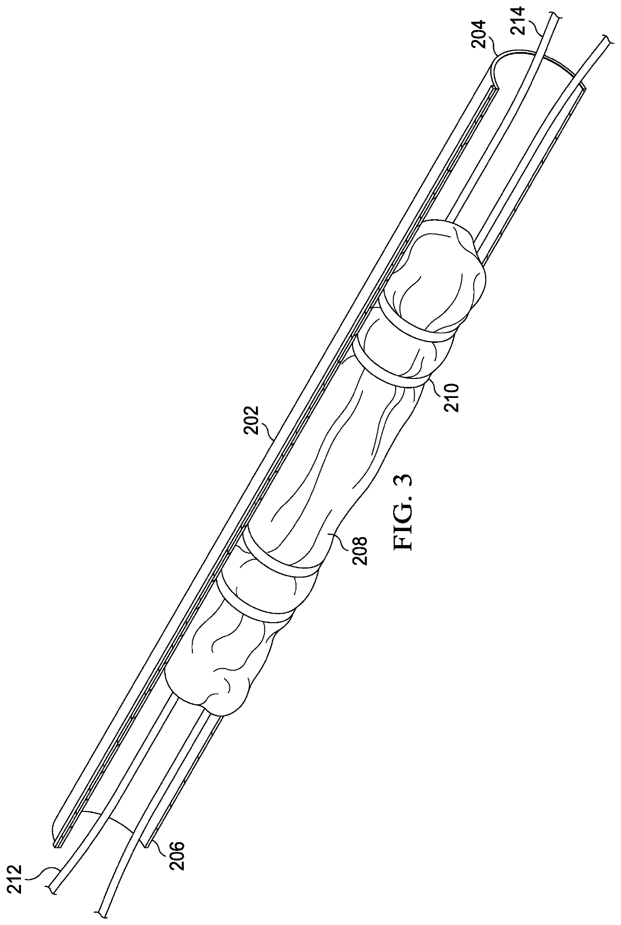 Graft Compression System