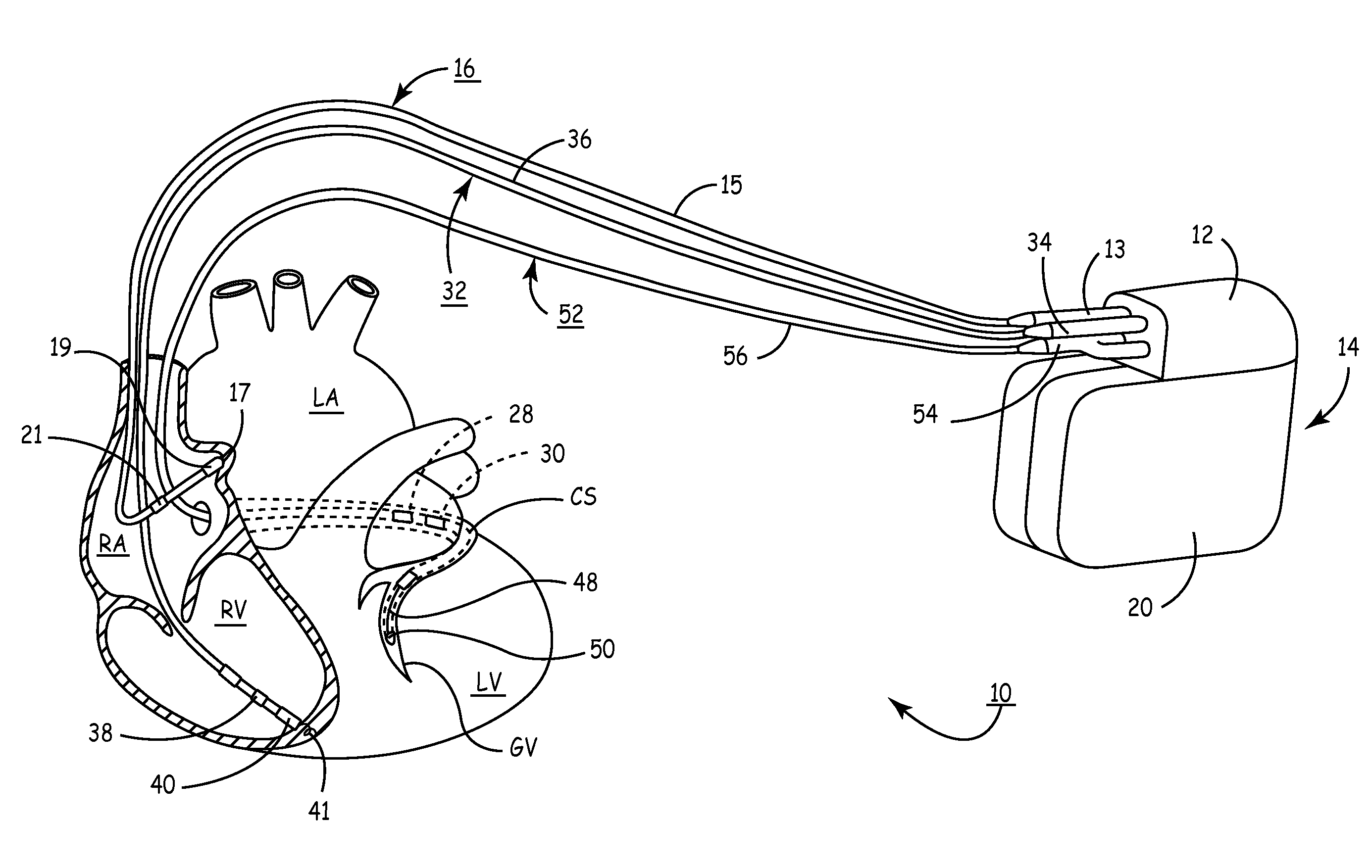 Apparatus and methods for automatic adjustment of av interval to ensure delivery of cardiac resynchronization therapy