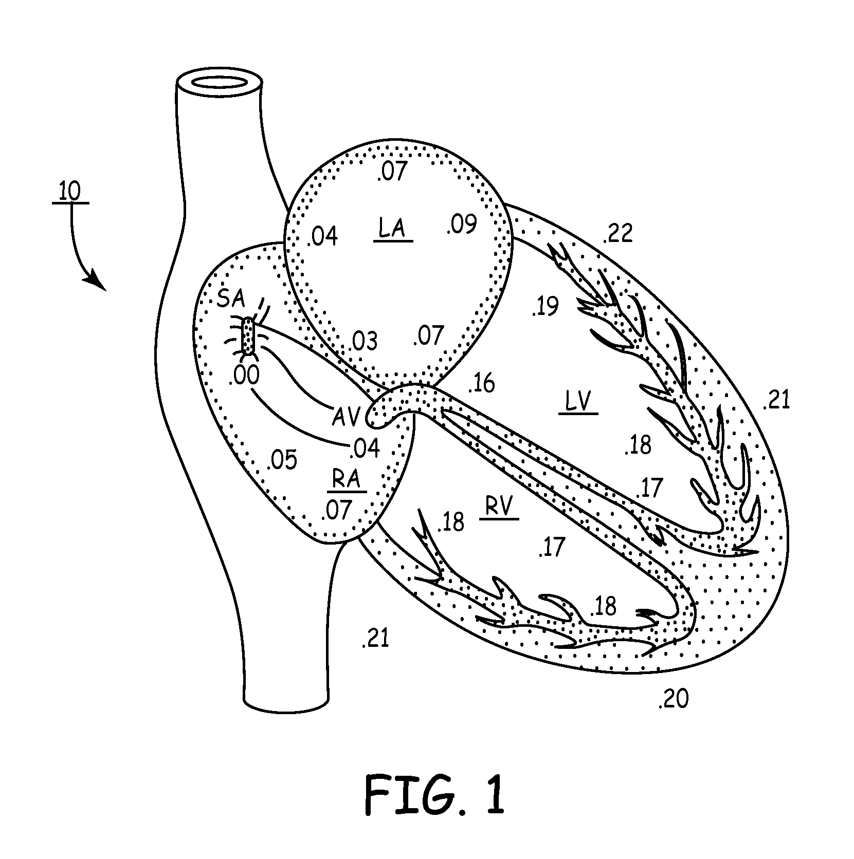 Apparatus and methods for automatic adjustment of av interval to ensure delivery of cardiac resynchronization therapy