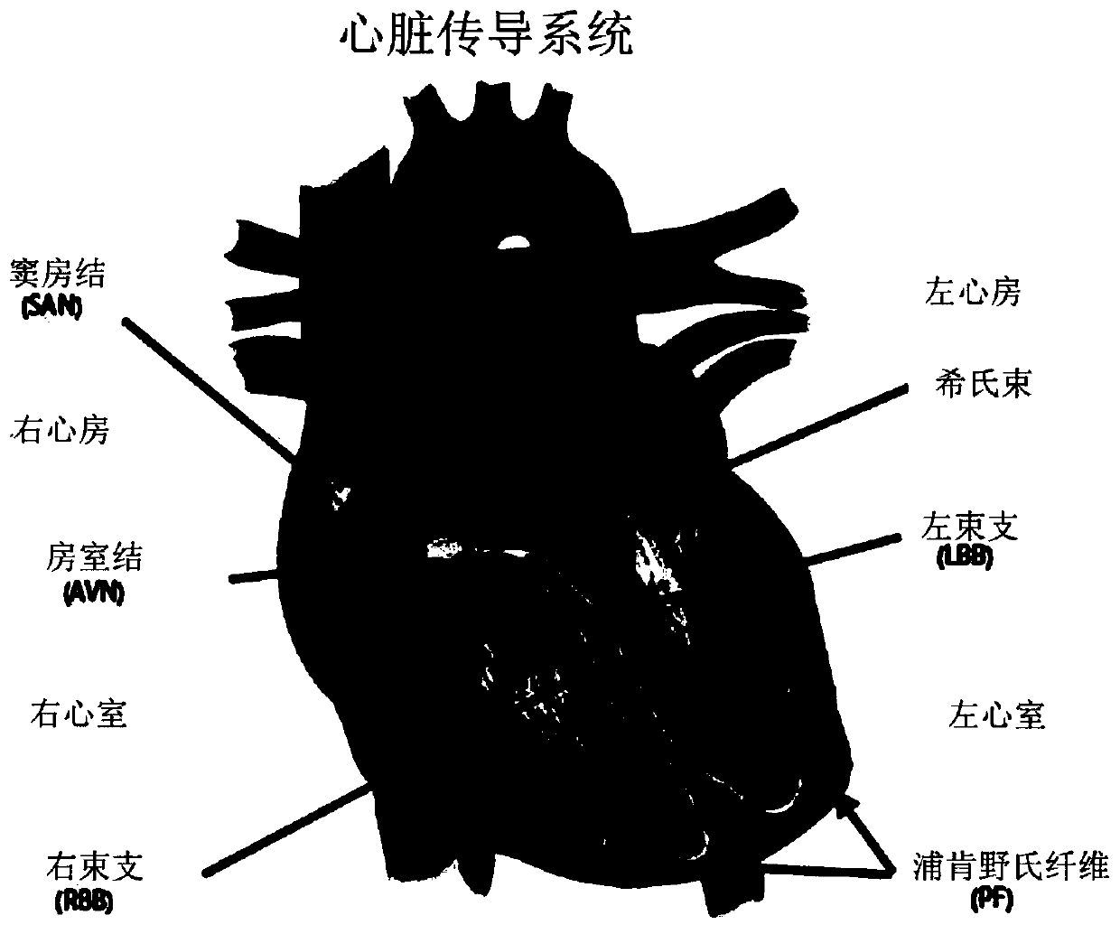 Pacemaker lead for cerclage pacing