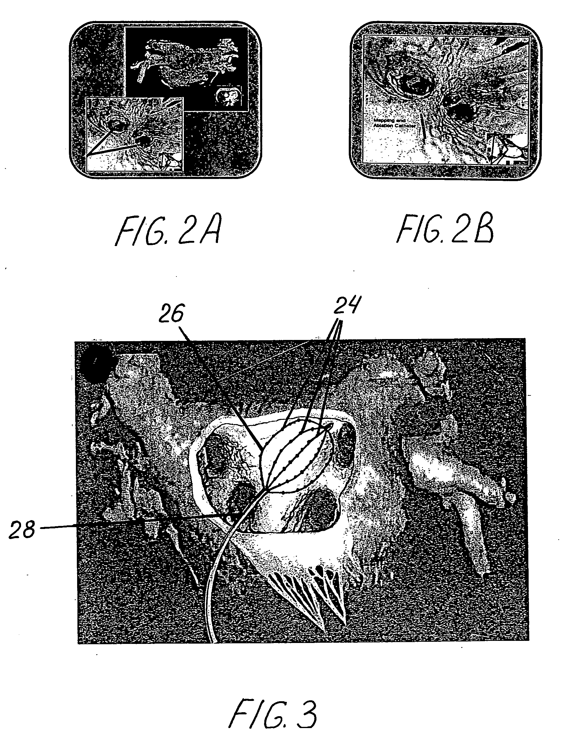 Method and system for ablation of atrial fibrillation and other cardiac arrhythmias