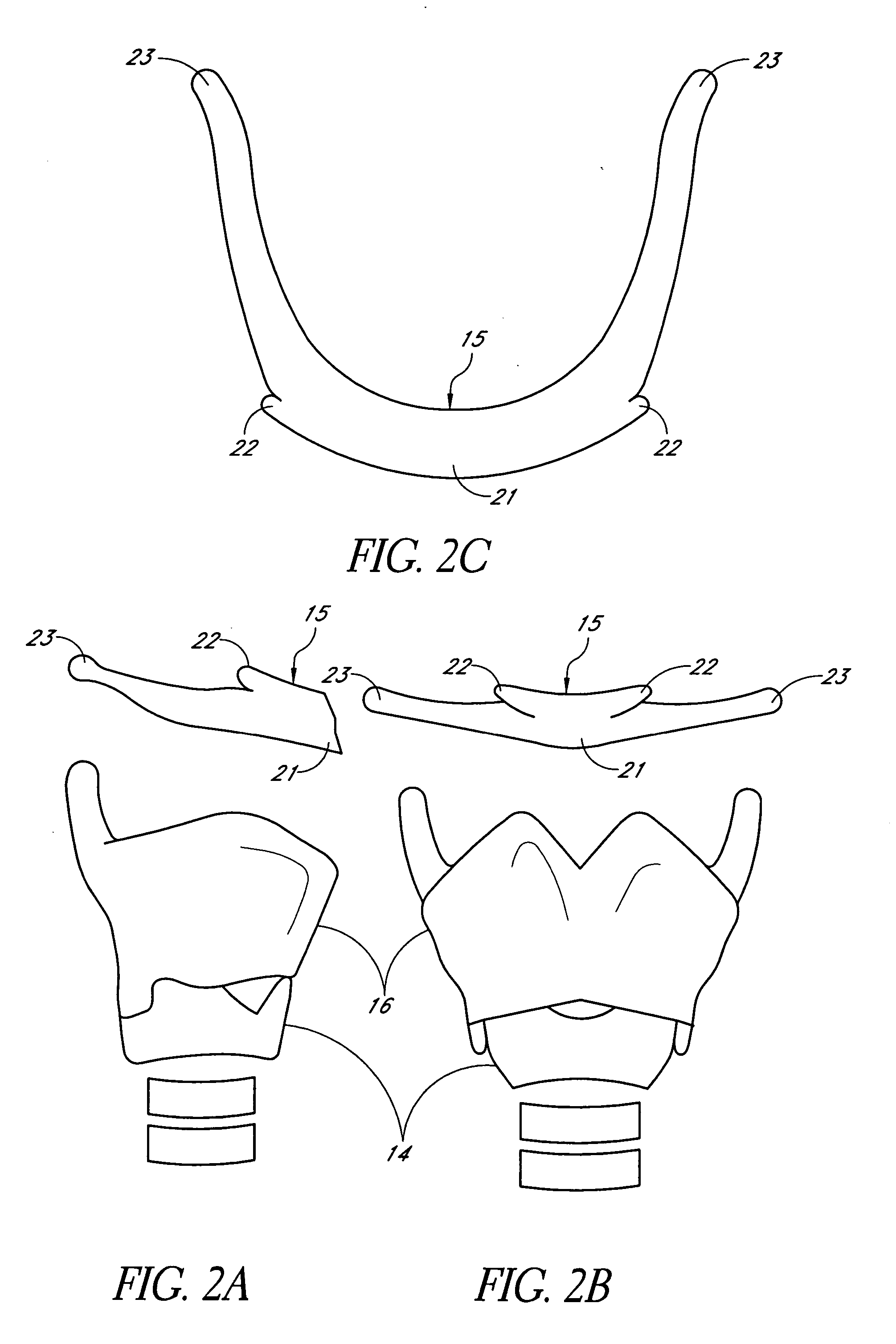 System and method for hyoidplasty