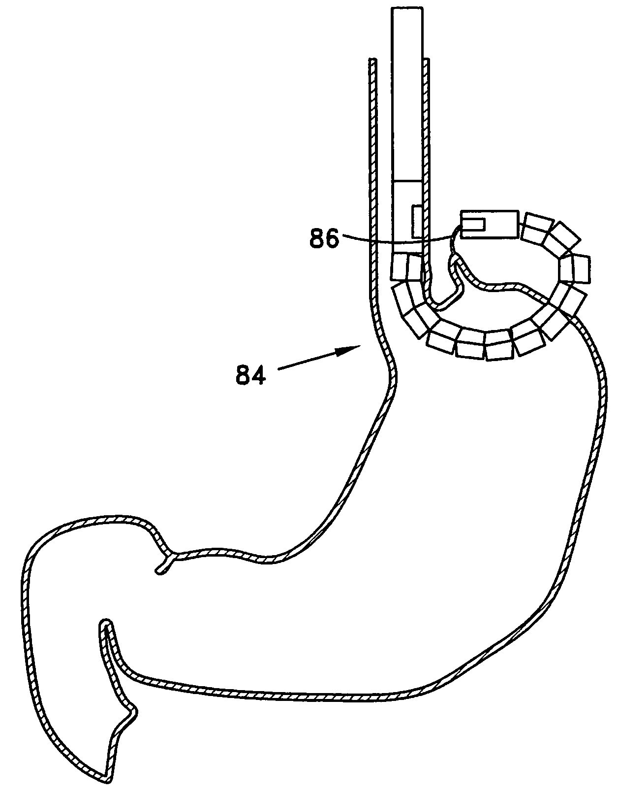 Transgastric method for carrying out a partial fundoplication