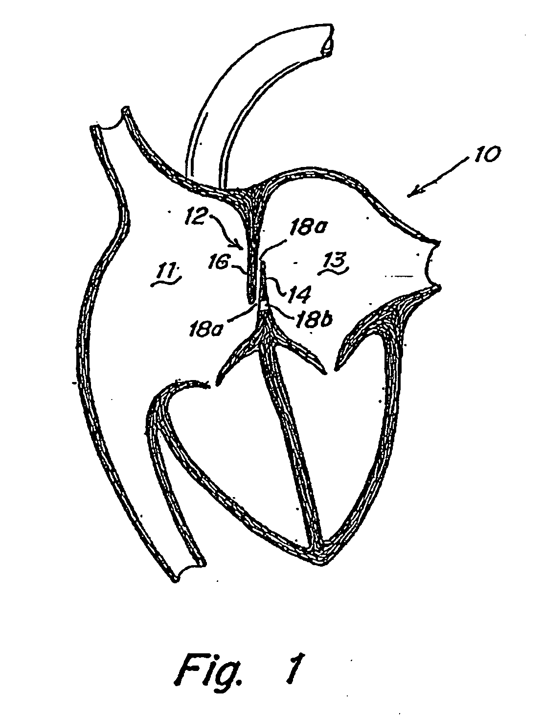Catch system with locking cap for patent foramen ovale (PFO) occluder