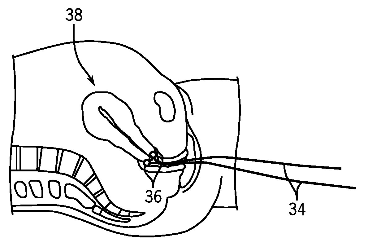 Uterine electrical stimulation system and method