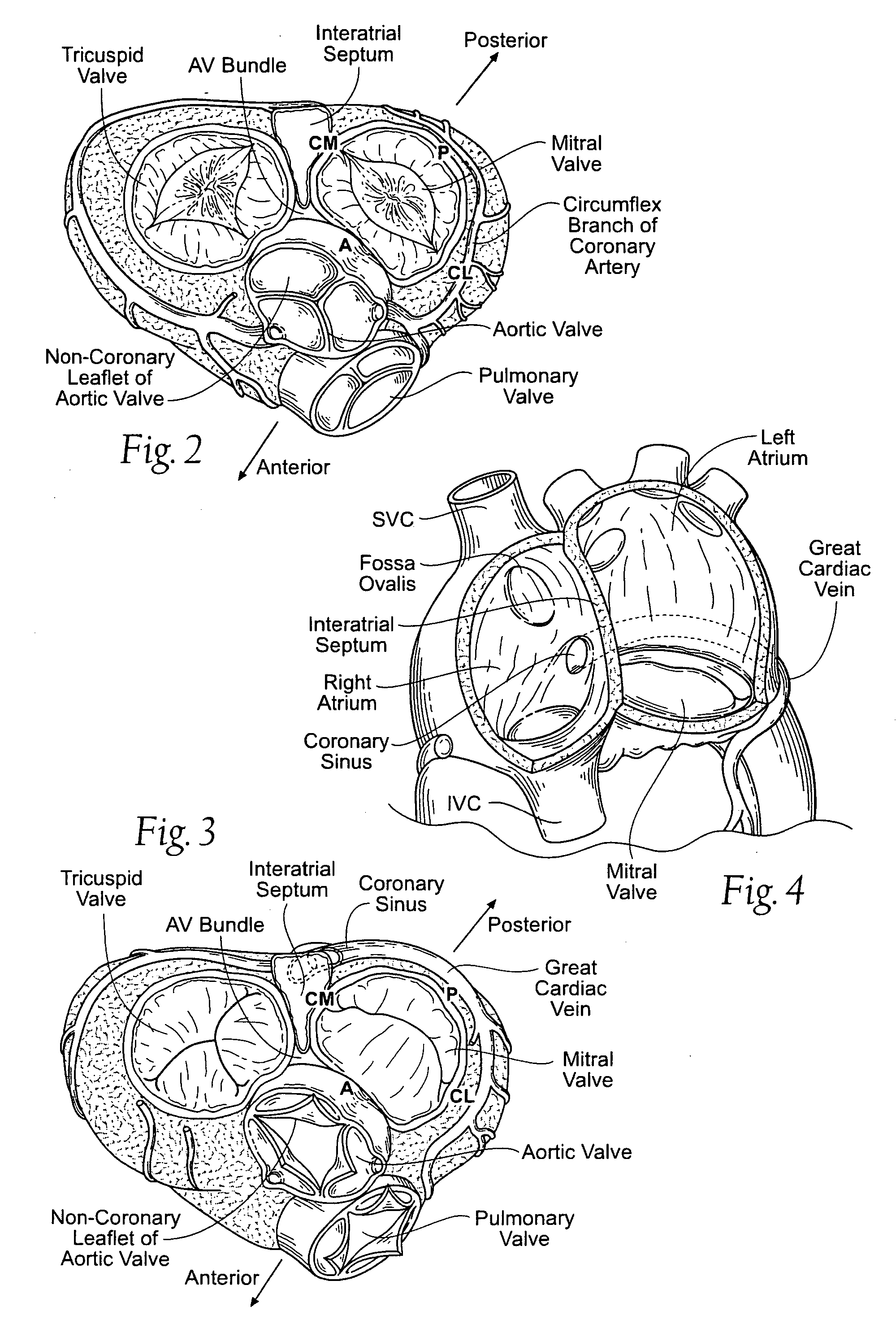 Devices, systems, and methods for reshaping a heart valve annulus, including the use of a bridge implant having an adjustable bridge stop