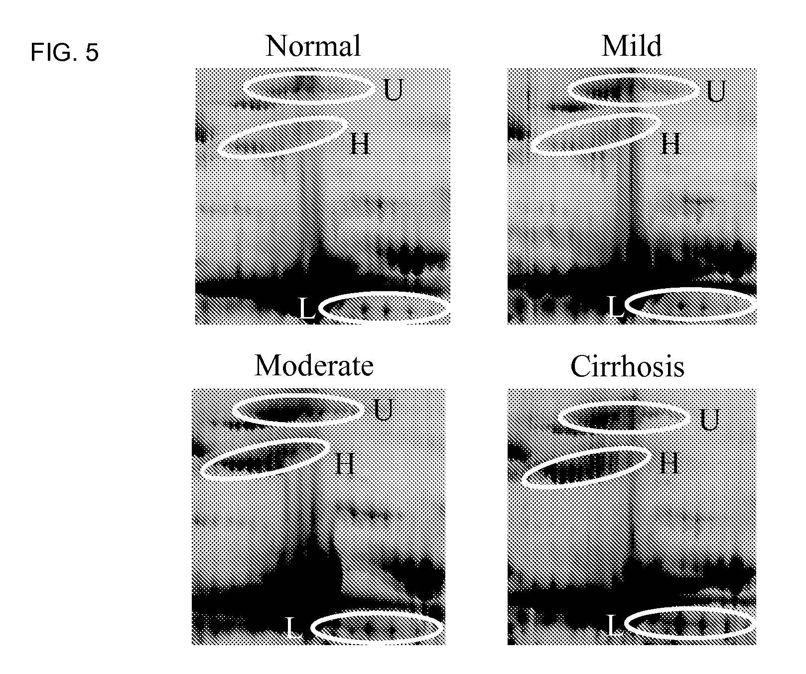 Clinical diagnosis of hepatic fibrosis using a novel panel of human serum protein biomarkers