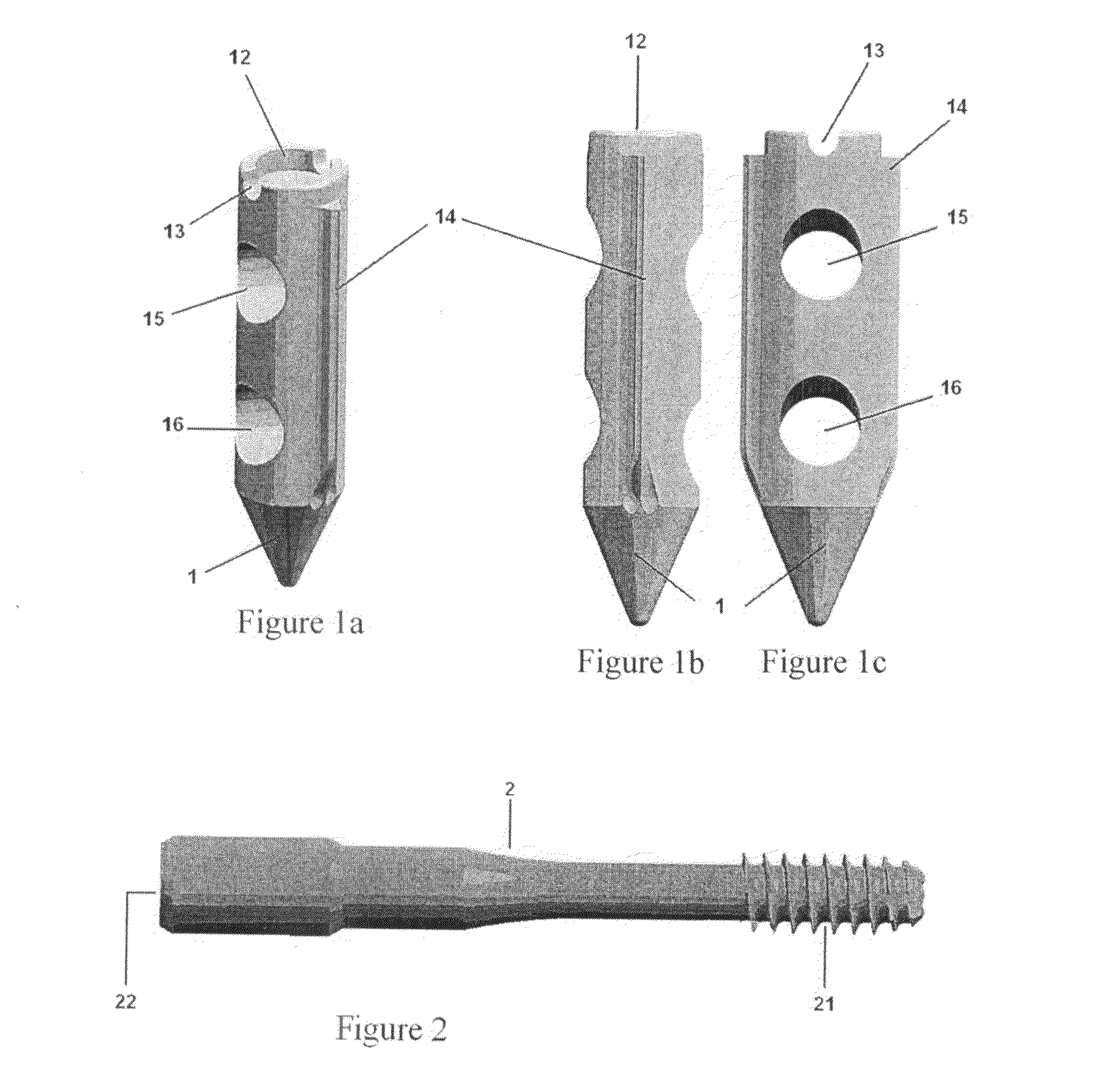 Locking nail system for arthrodesis reconstruction in calcaneus fractures