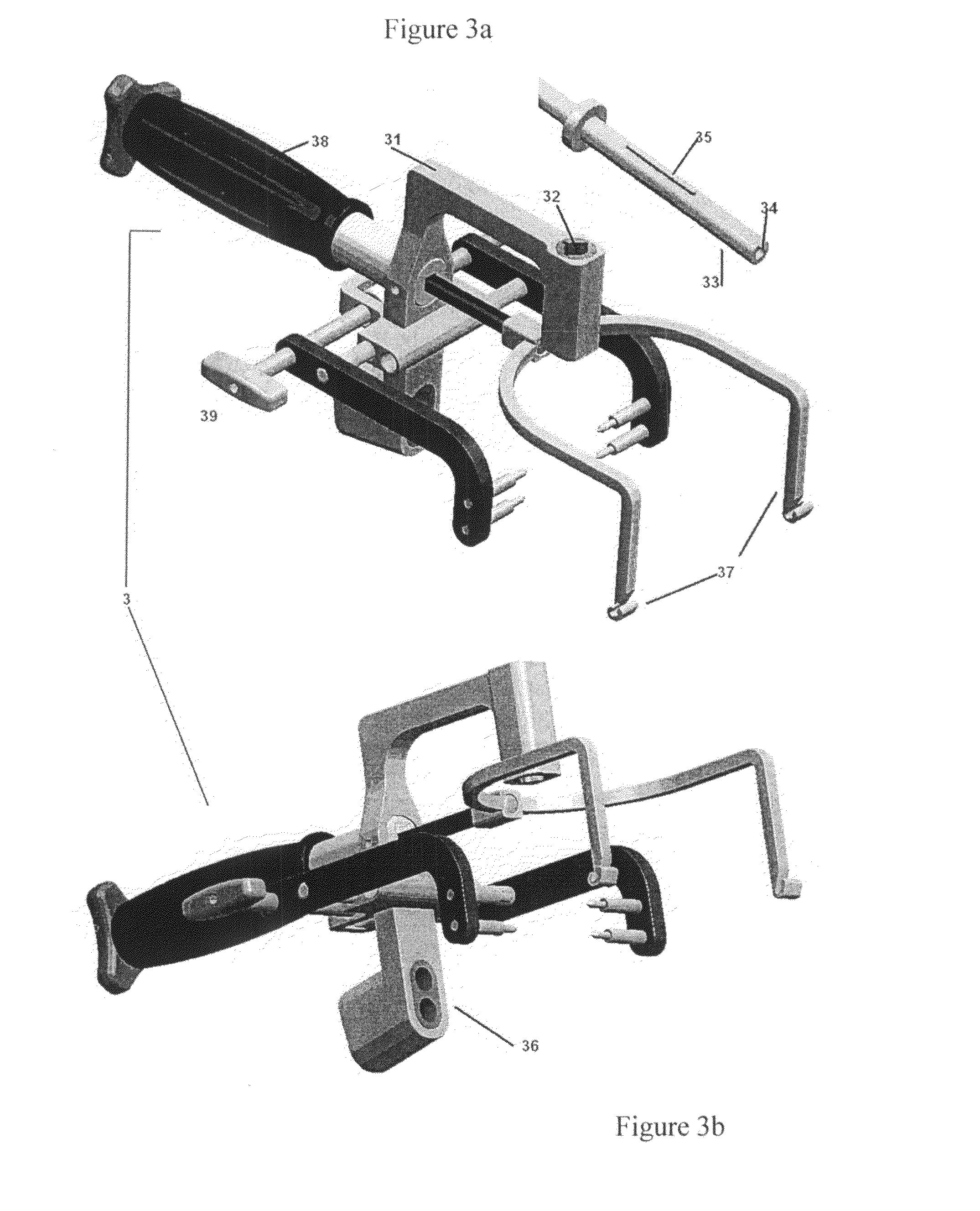 Locking nail system for arthrodesis reconstruction in calcaneus fractures