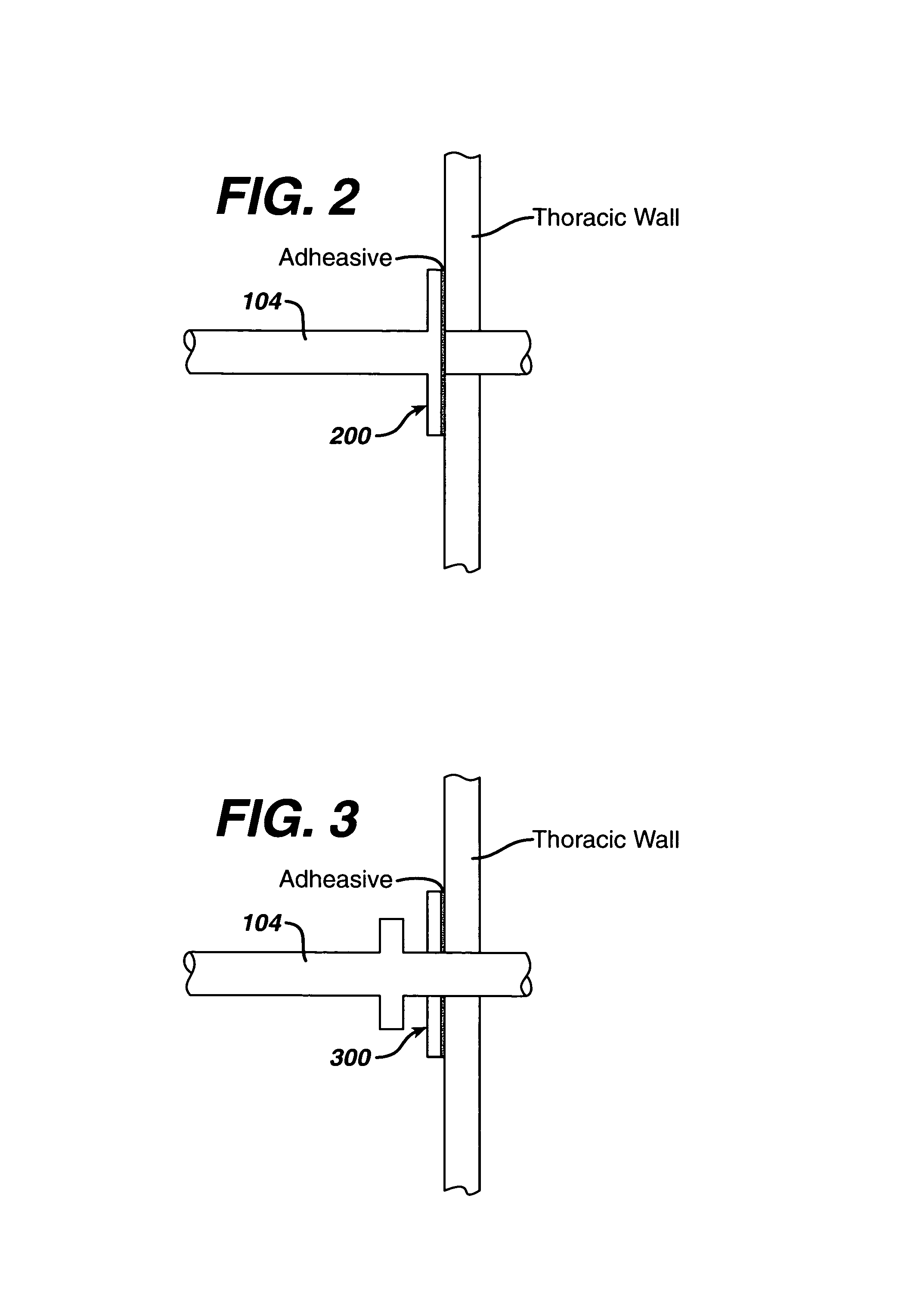 Evacuation device and method for creating a localized pleurodesis