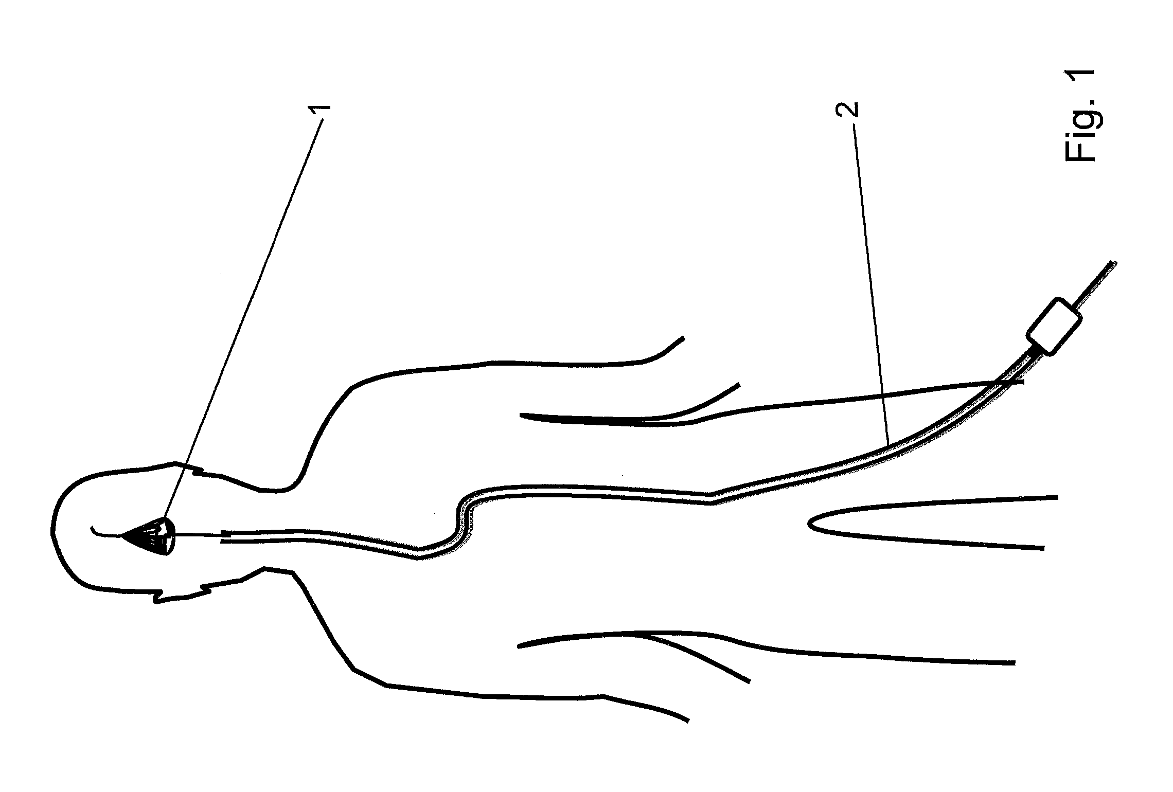 Clot capture systems and associated methods