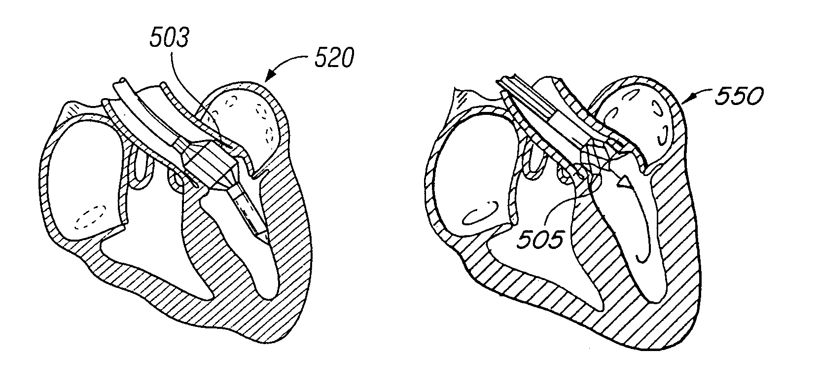Endoluminal cardiac and venous valve prostheses and methods of manufacture and delivery thereof