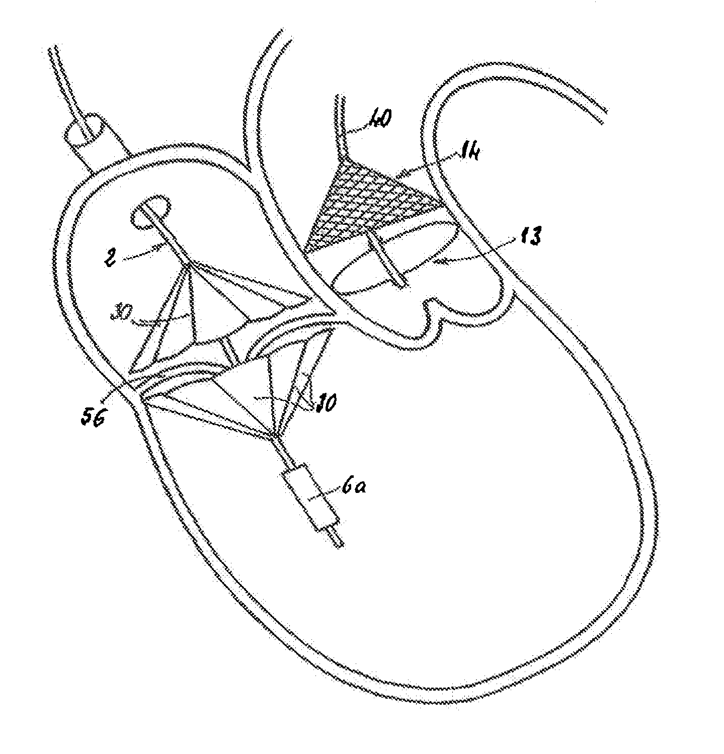 Prosthetic Valve For Transluminal Delivery