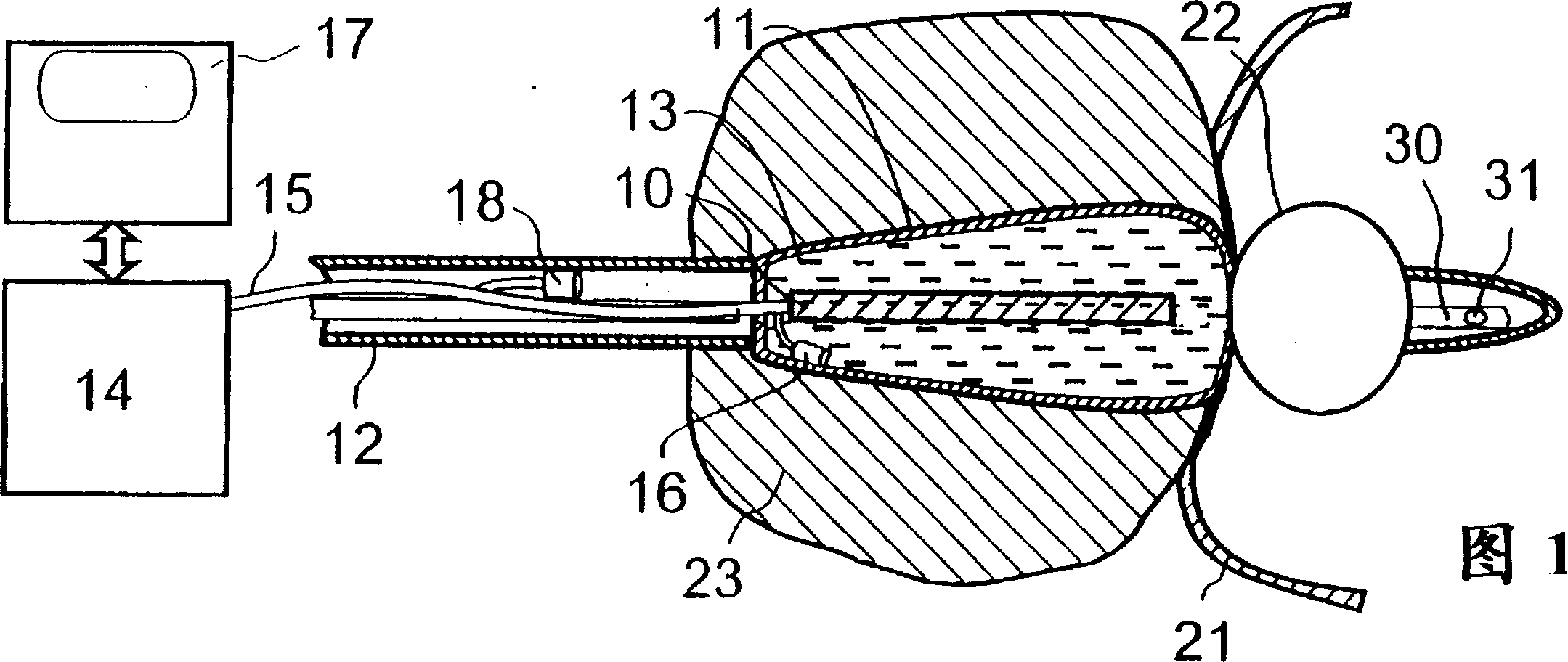 Device for local heat treatment of tissue