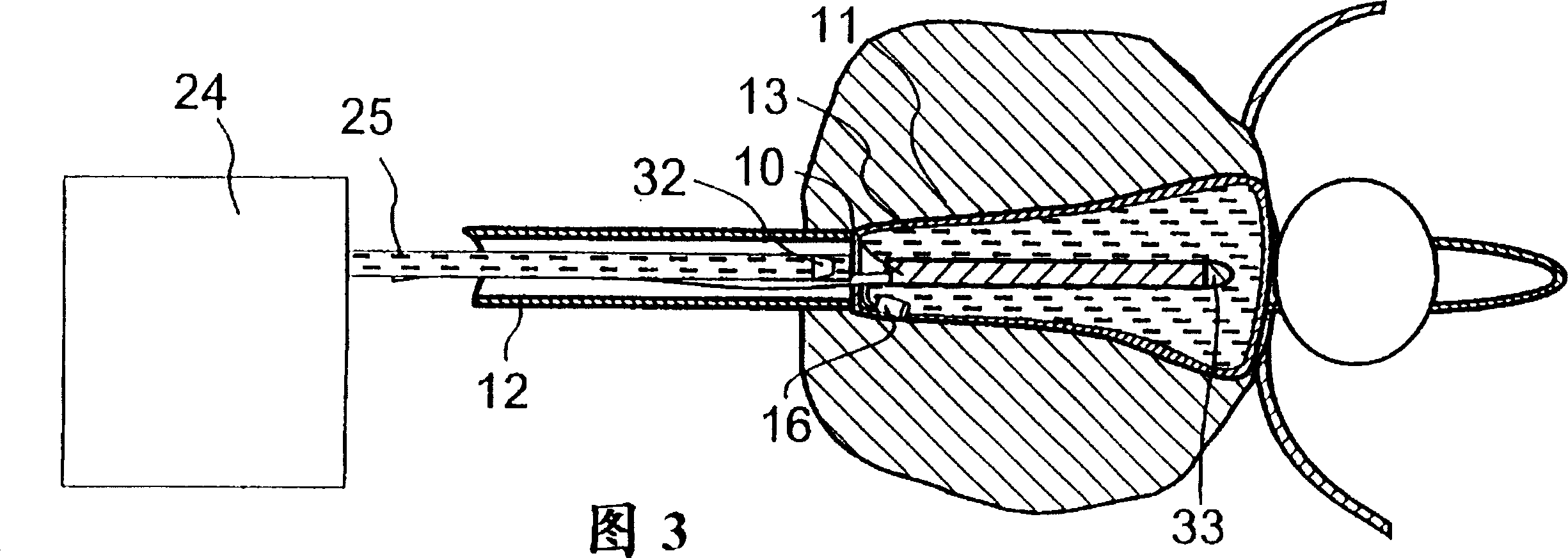 Device for local heat treatment of tissue