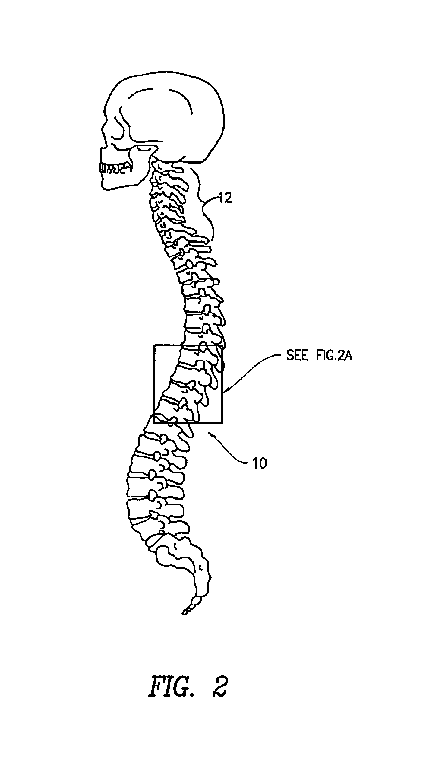 Method of delivering a TNF antagonist to the brain of a human by perispinal administration without direct intrathecal injection