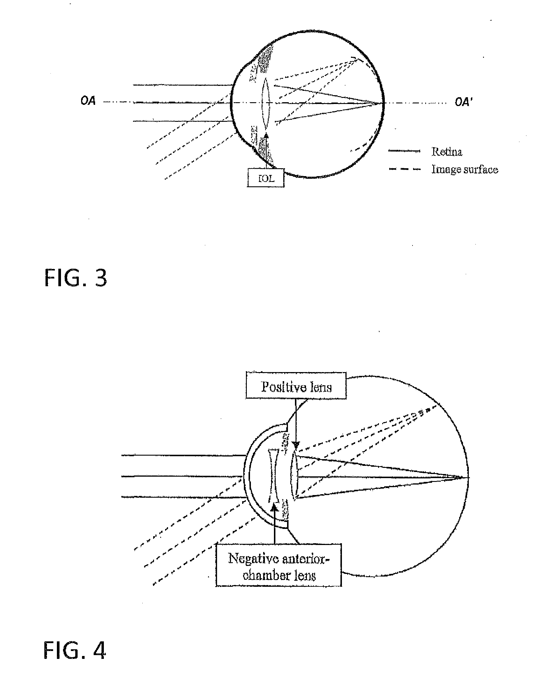 Intraocular lens that matches an image surface to a retinal shape, and method of designing same