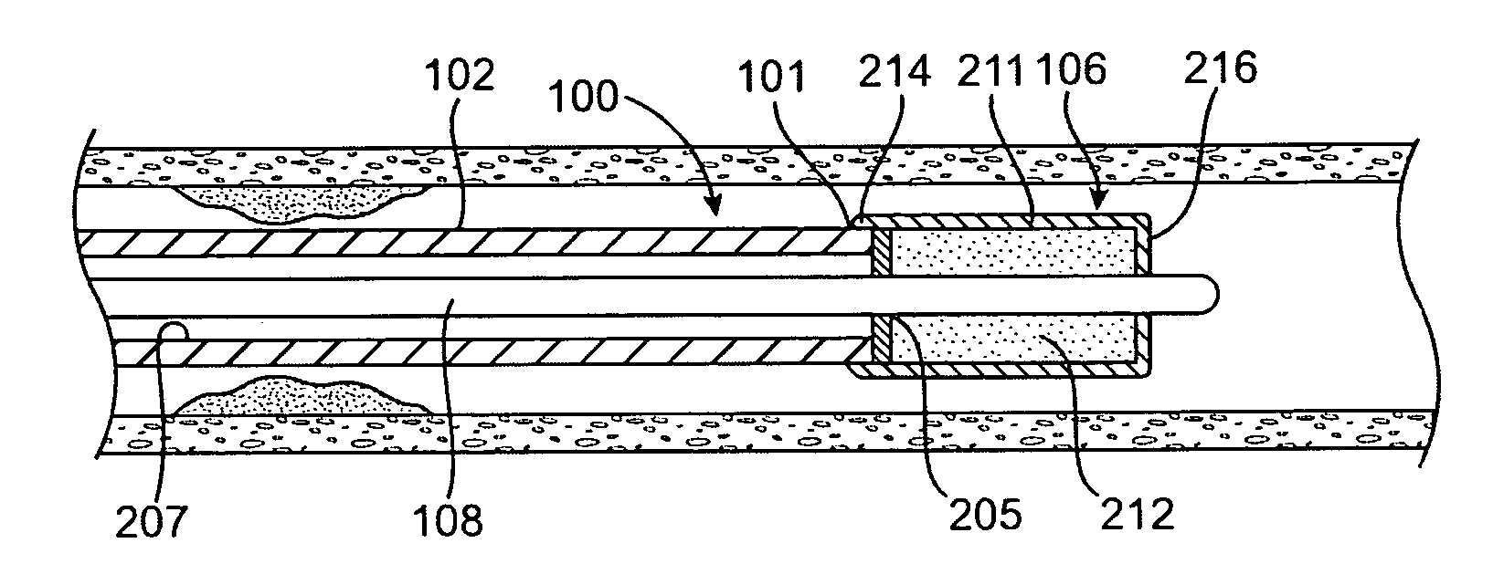 Device with actuatable fluid-column occluder for prevention of embolization