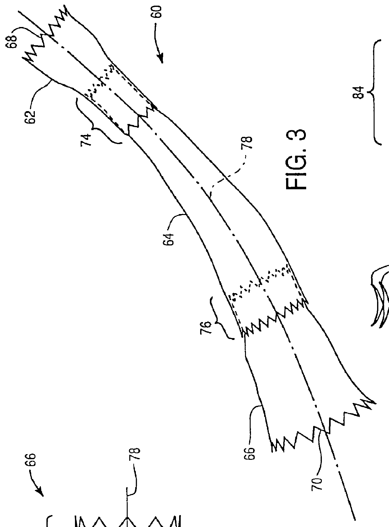 Stitched stent grafts and methods for their fabrication
