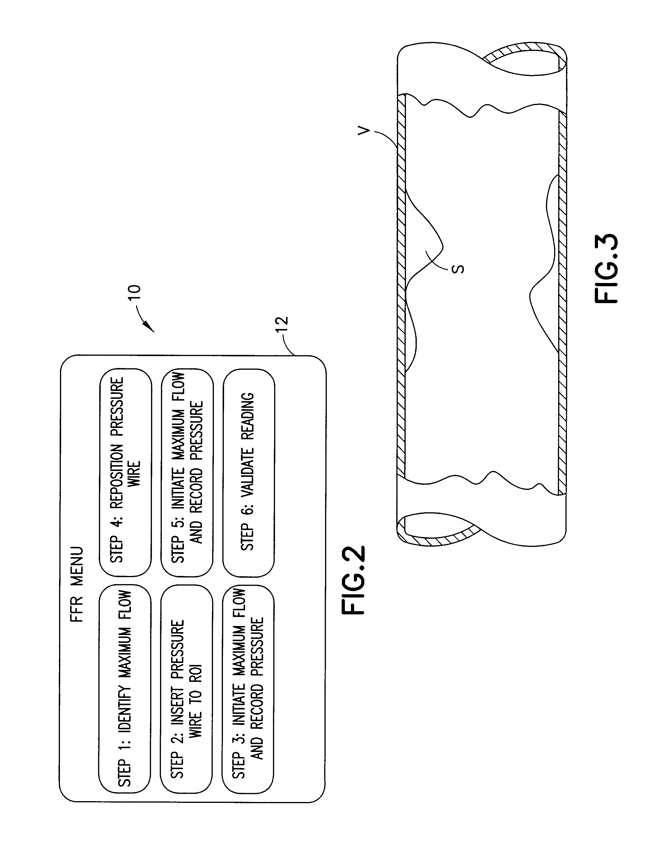 Method and apparatus for fractional flow reserve measurements