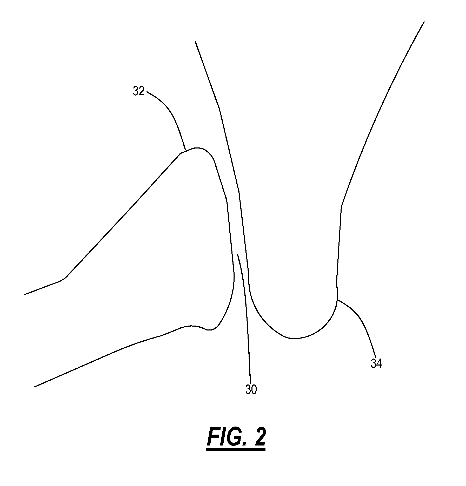 Facet distraction device, facet joint implant, and associated methods