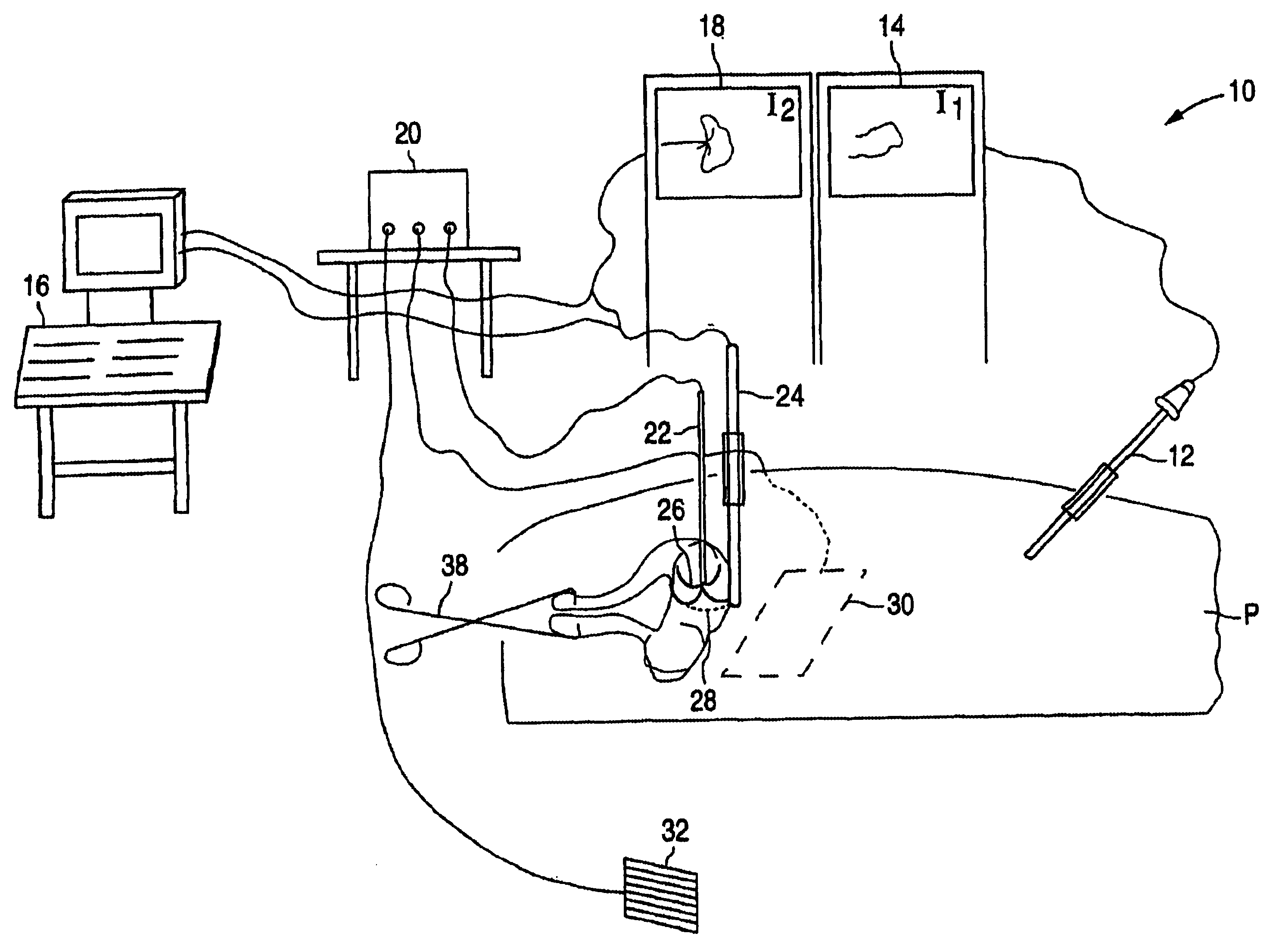 Gynecological ablation procedure and system using an ablation needle