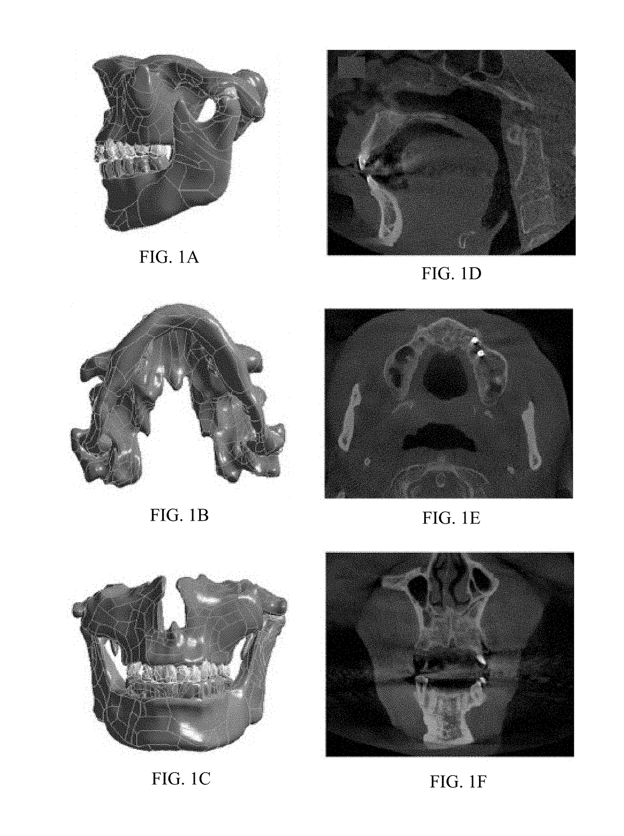 Prosthesis for dental replacement, method of redistributing stress and stress analysis method