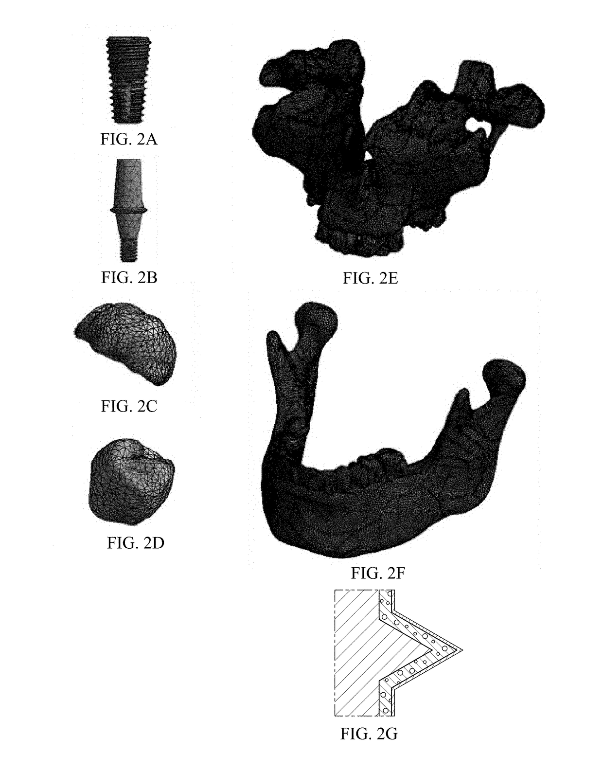 Prosthesis for dental replacement, method of redistributing stress and stress analysis method