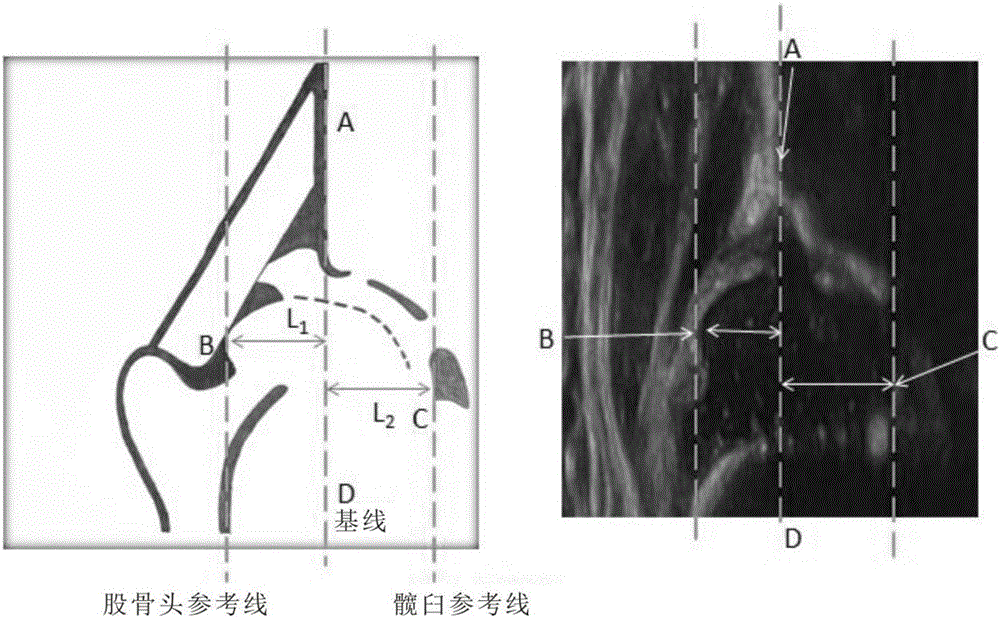 Measurement system and method of acetabular bone coverage degree based on ultrasonic image