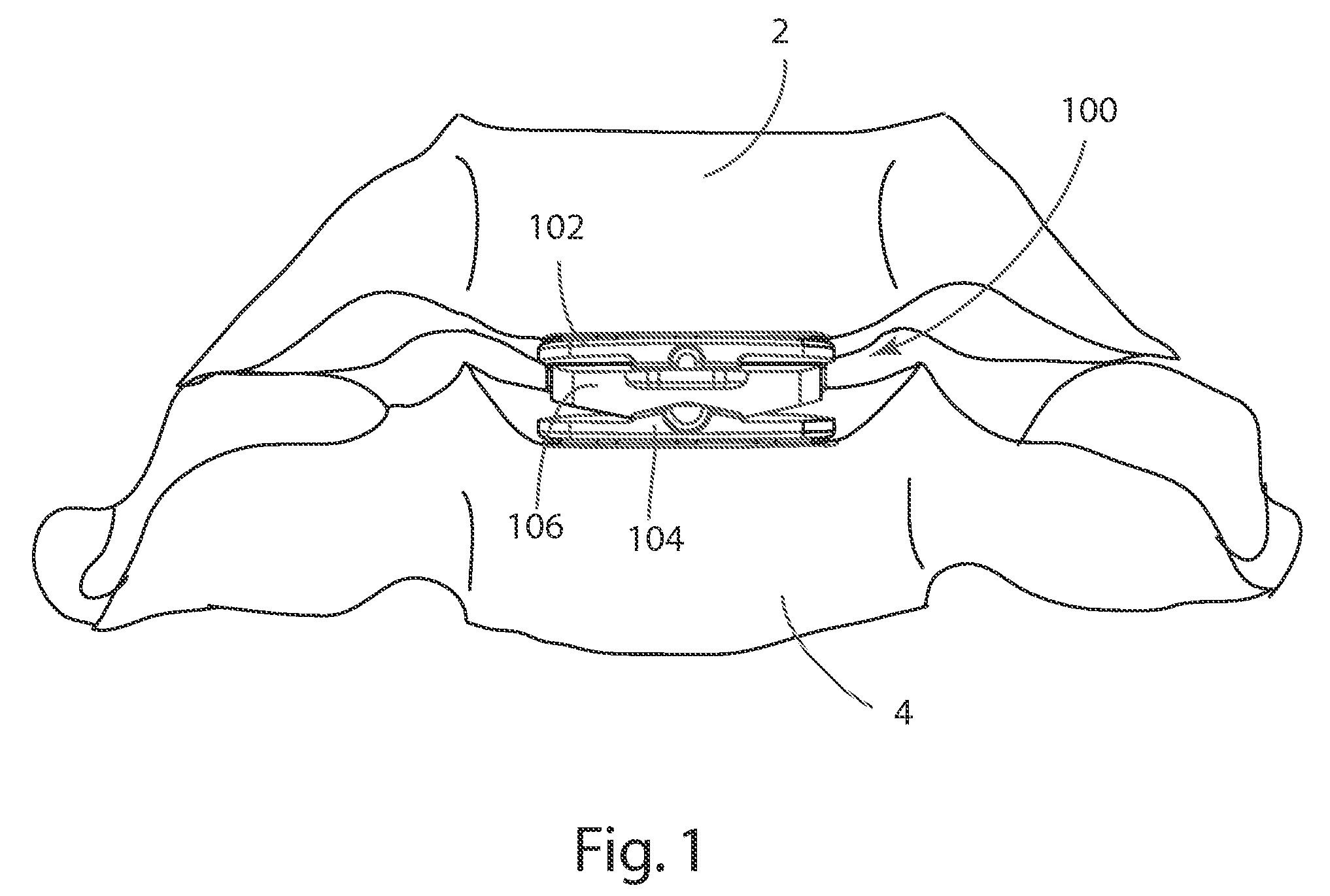 Systems and Methods for Vertebral Disc Replacement
