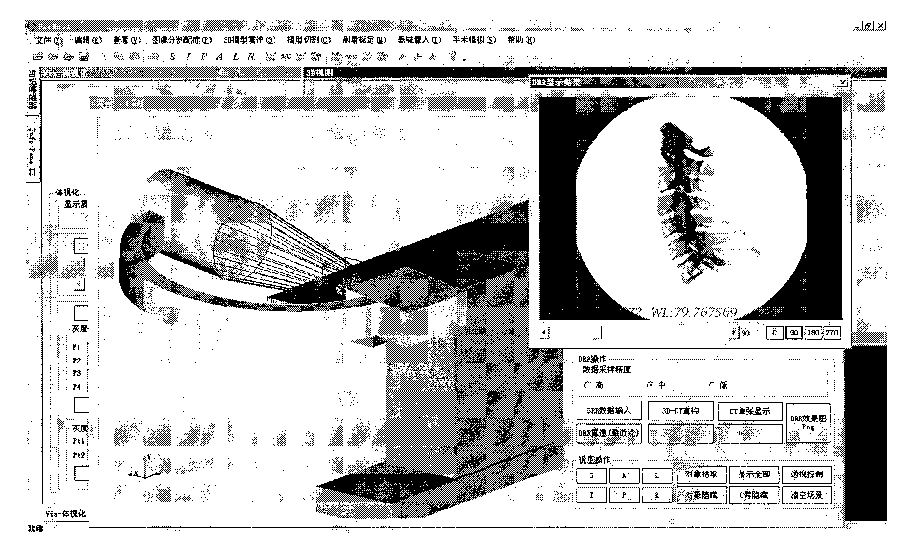 Intraoperative registration method for correcting preoperative three-dimensional image and device