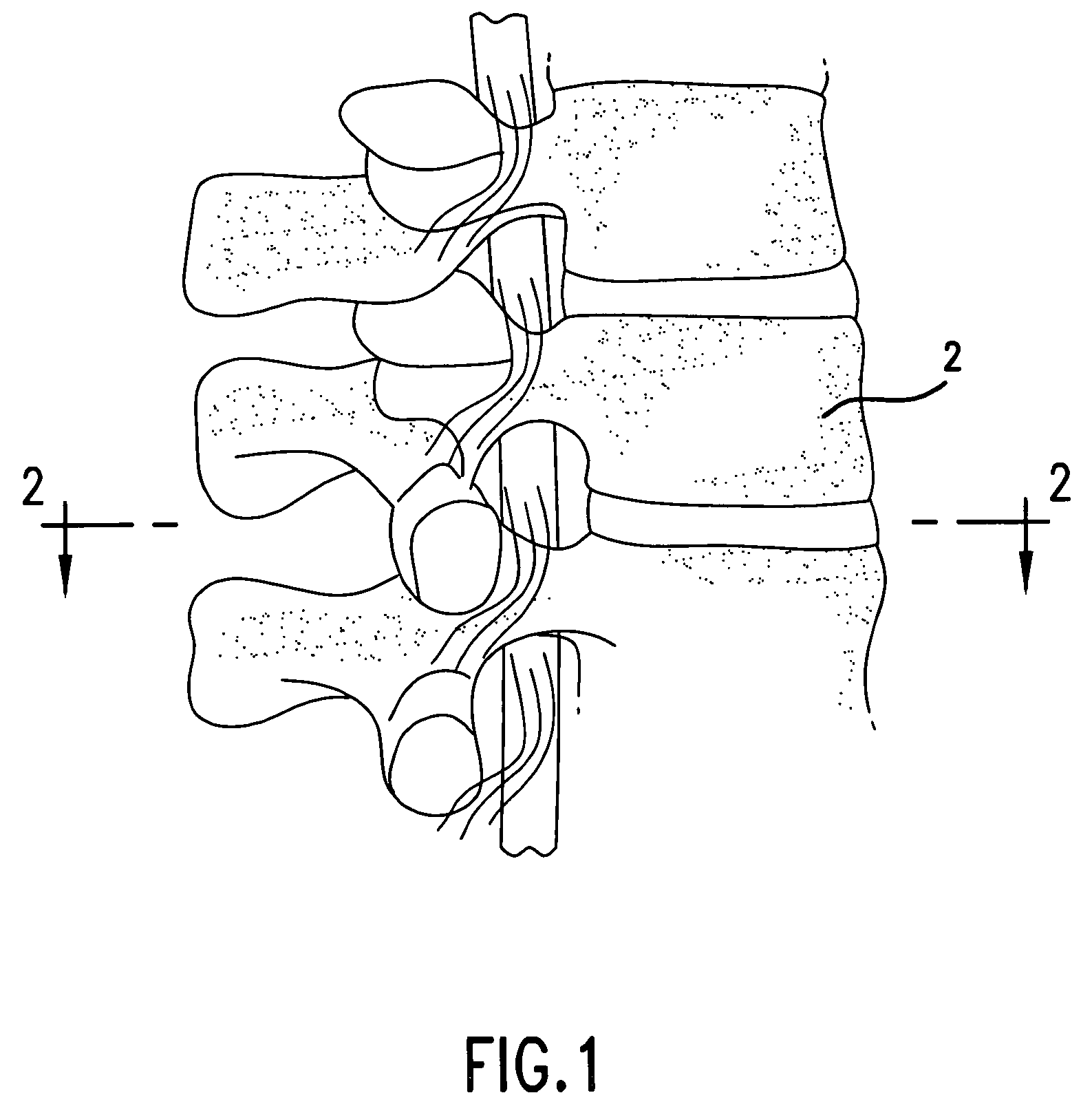 Device and method for treatment of intervertebral disc disruption