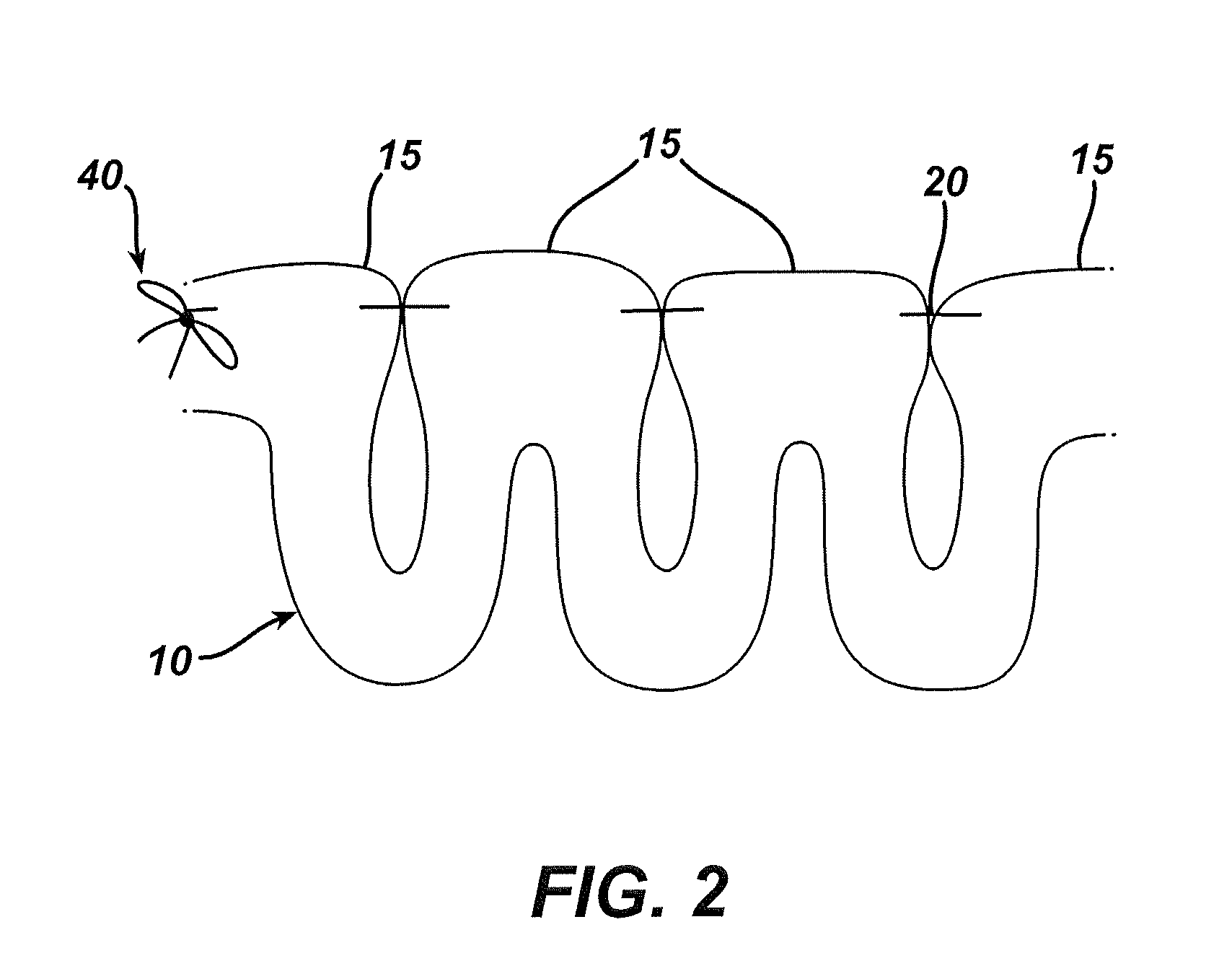 Methods and Devices For The Rerouting Of Chyme To Induct Intestinal Brake