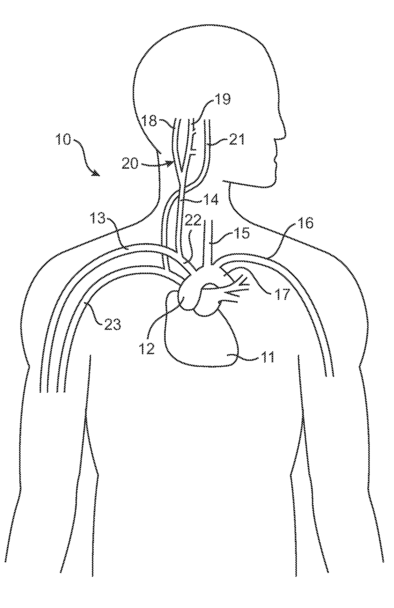Baroreflex activation therapy device with pacing cardiac electrical signal detection capability