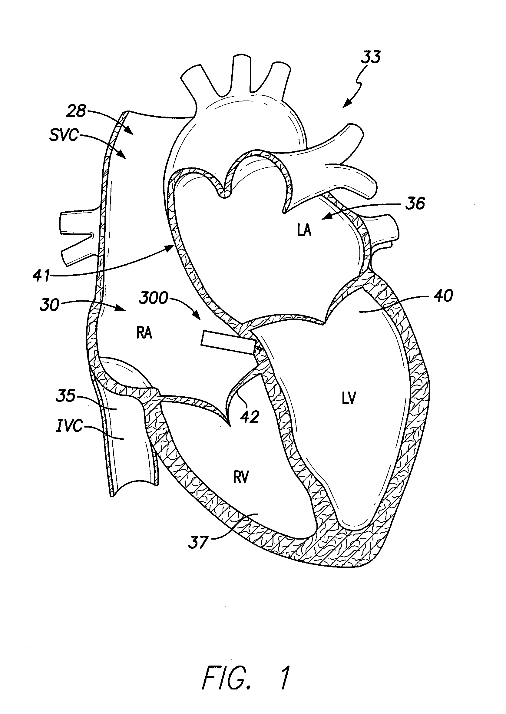 Single-chamber leadless intra-cardiac medical device with dual-chamber functionality